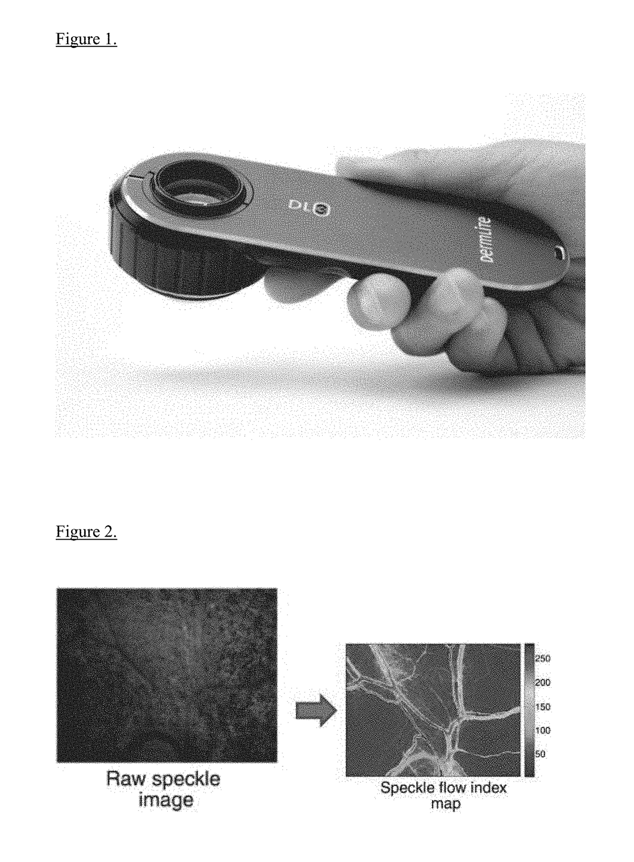 Handheld blood-flow imaging device