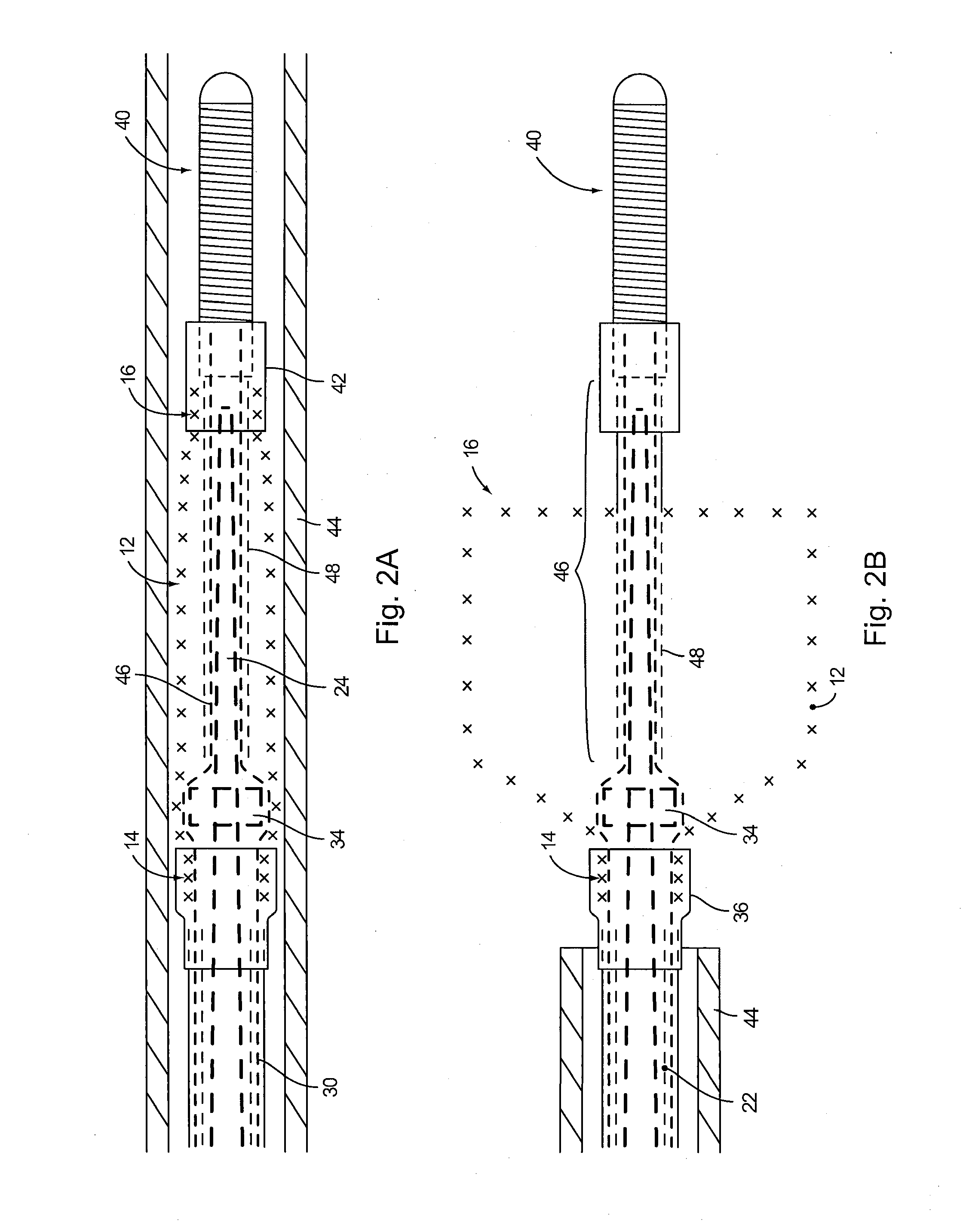 Braid Implant Delivery Systems