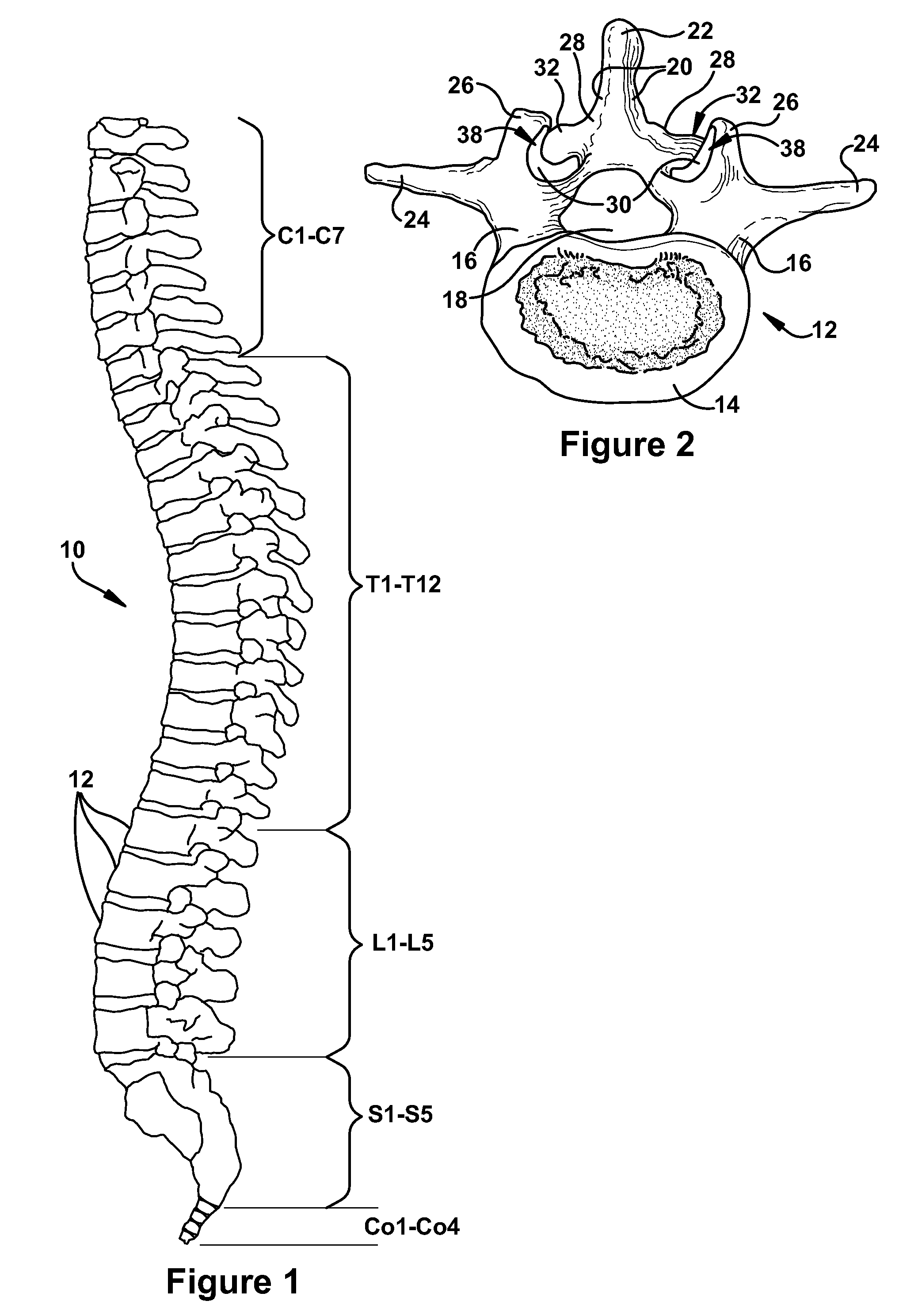 Orthopedic fixation mechanism