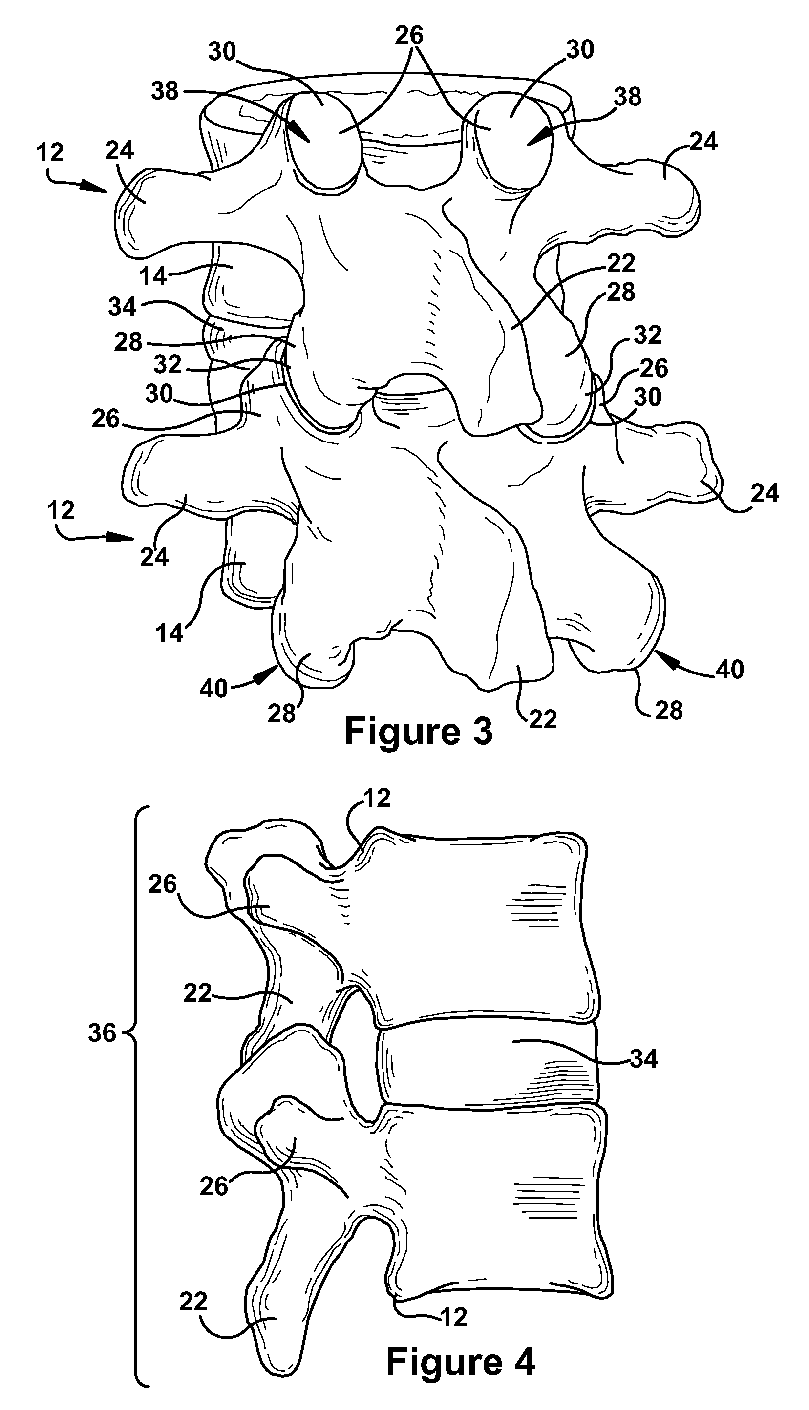 Orthopedic fixation mechanism