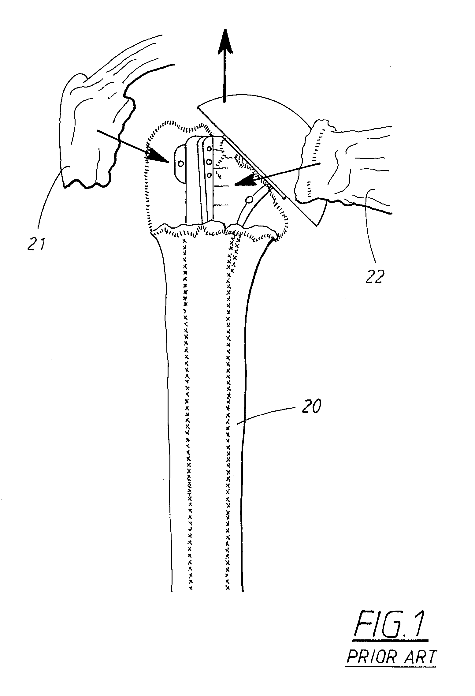 Shoulder prosthesis and a system for implanting a shoulder prosthesis