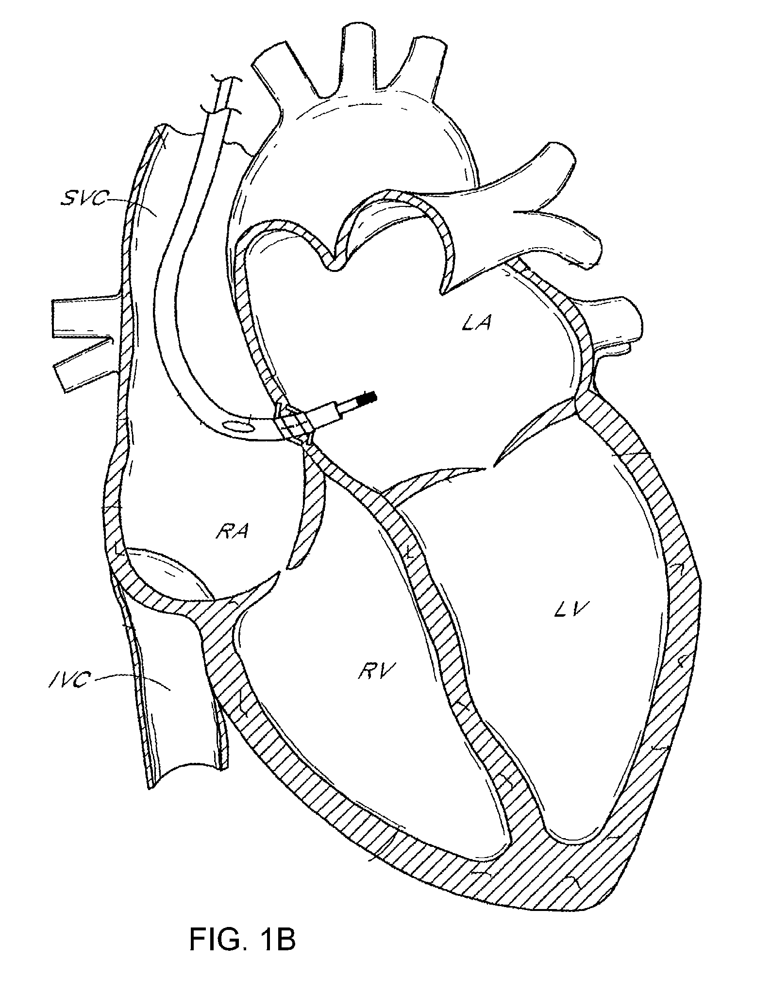 Analyzing circadian variations of a hemodynamic parameter to determine an adverse cardiac condition