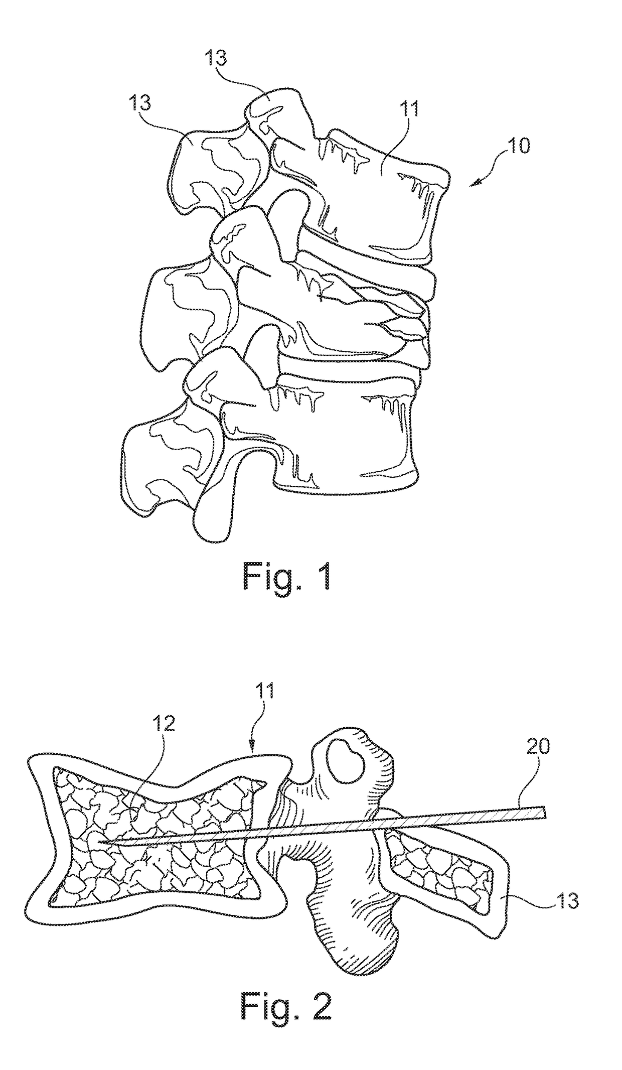 Biocompatible material in granules made of metal material or metal alloys and use of said granules for vertebroplasty