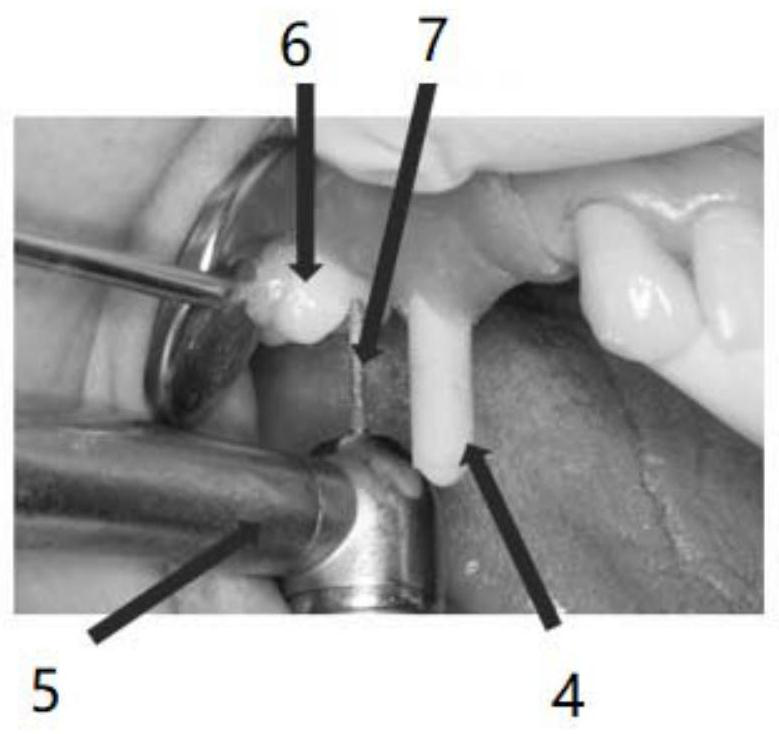 Digital transfer method and digital transfer system for partial removable denture common insertion path