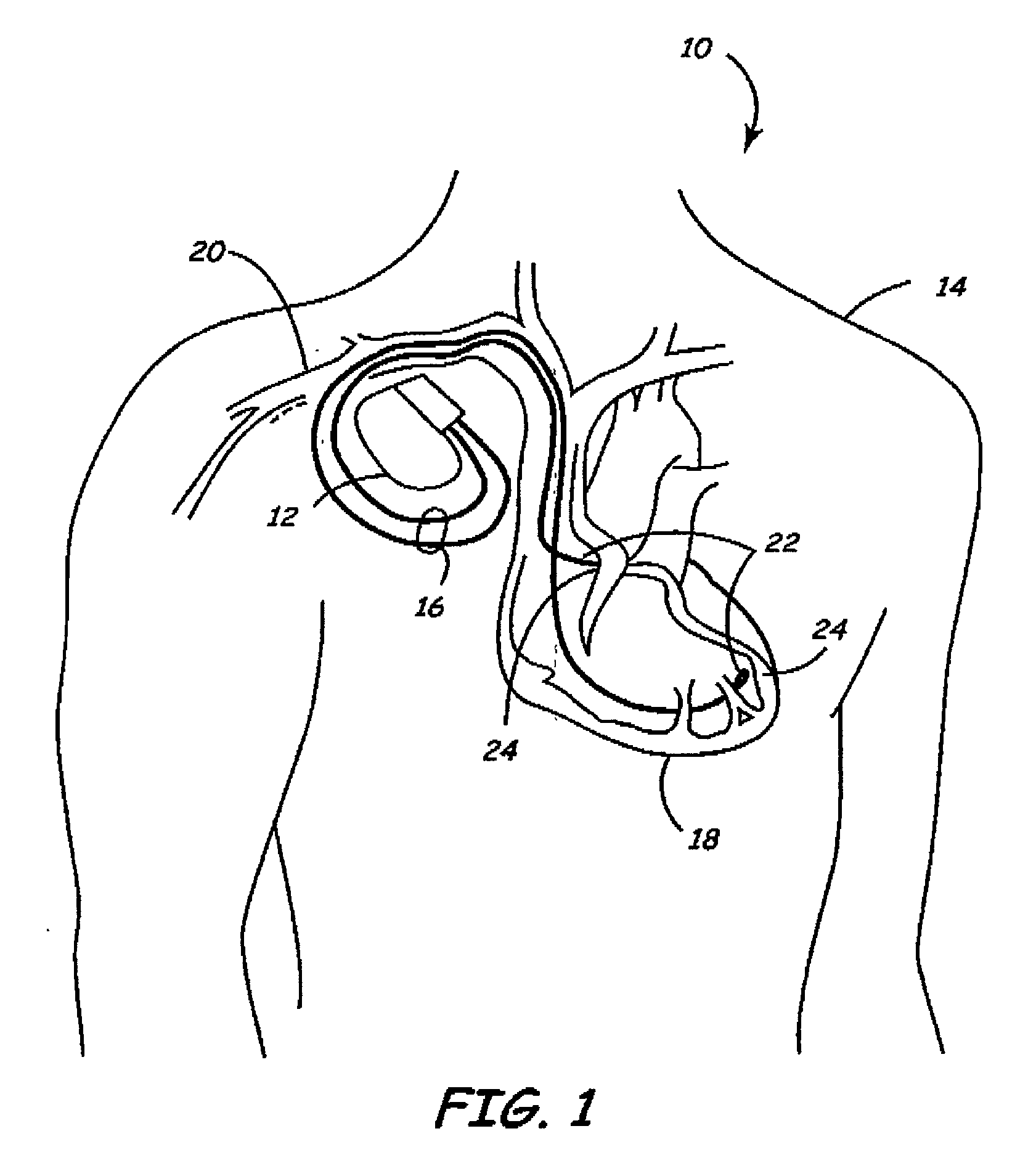 Medical implantable system for reducing magnetic resonance effects