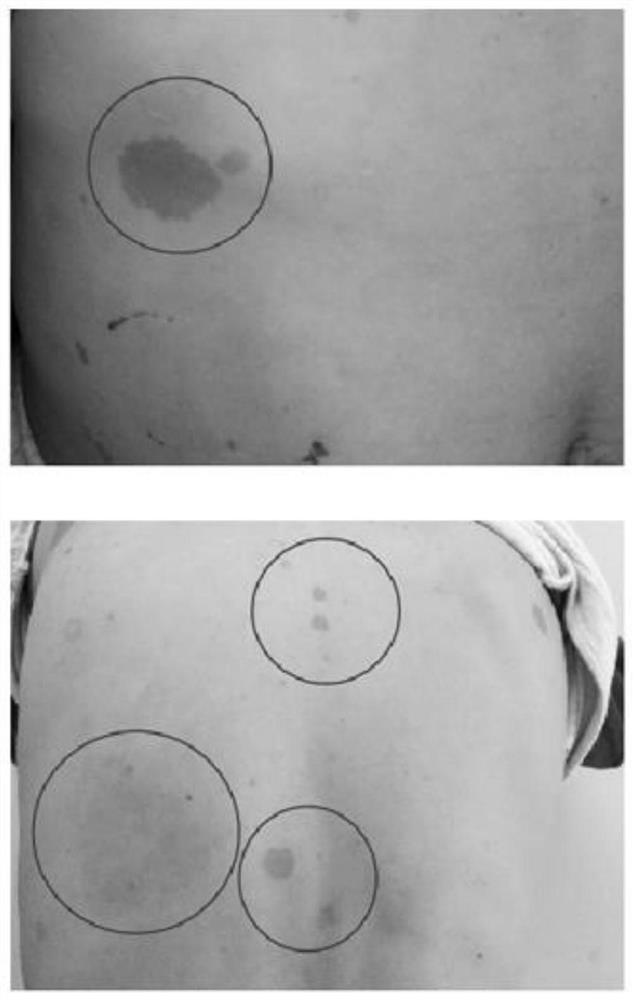 A new nf1 mutation-causing gene and its application and kit