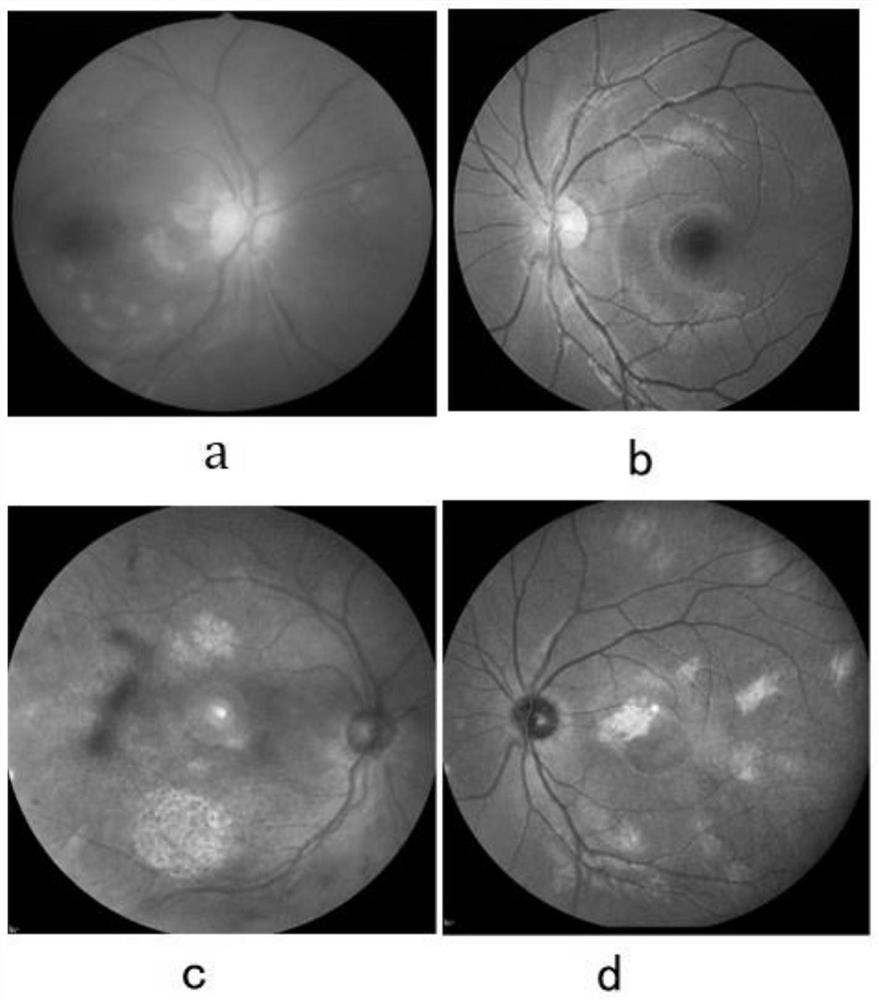 A new nf1 mutation-causing gene and its application and kit