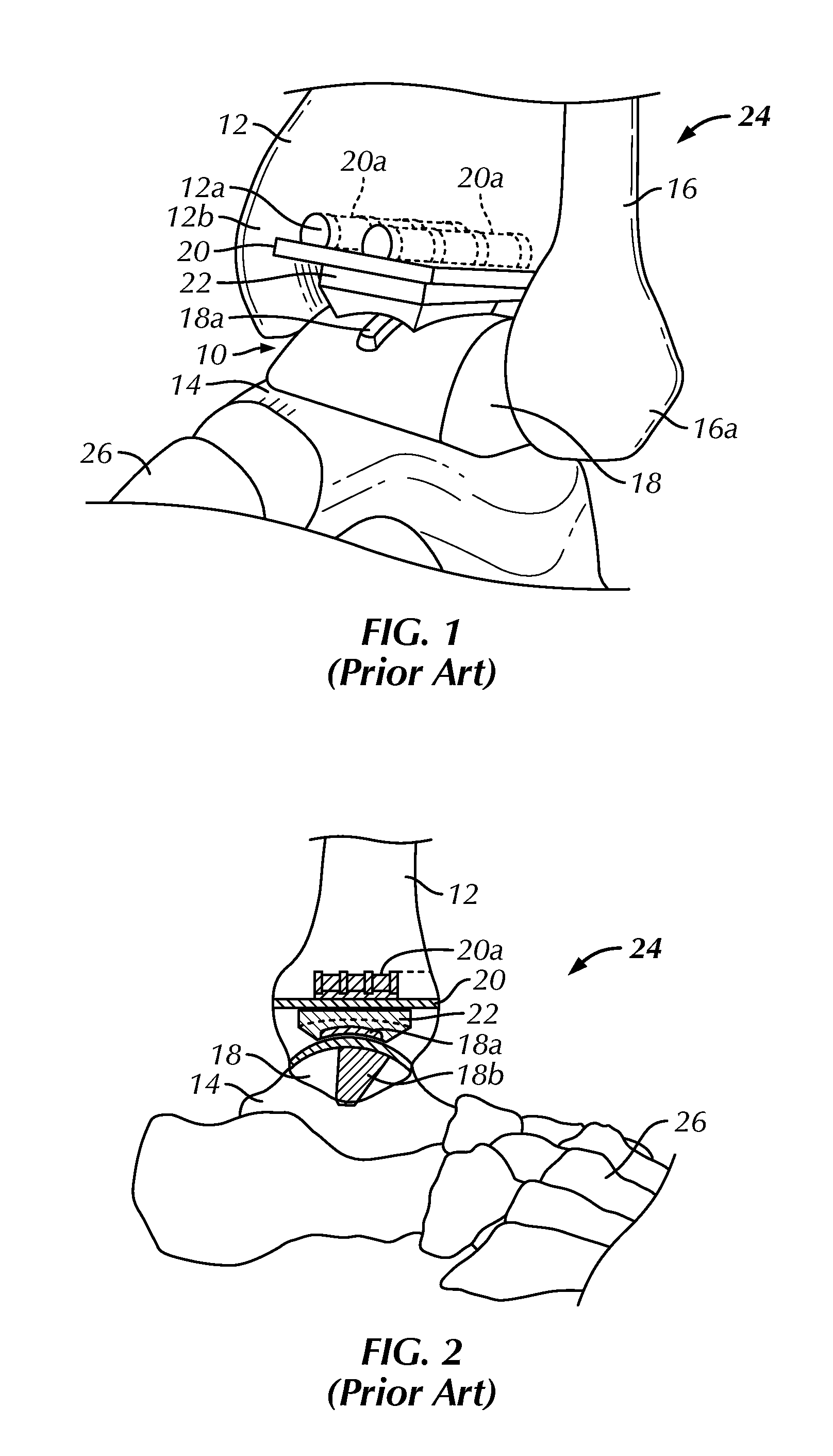 Surgical instrumentation and methods of use for implanting a prosthesis