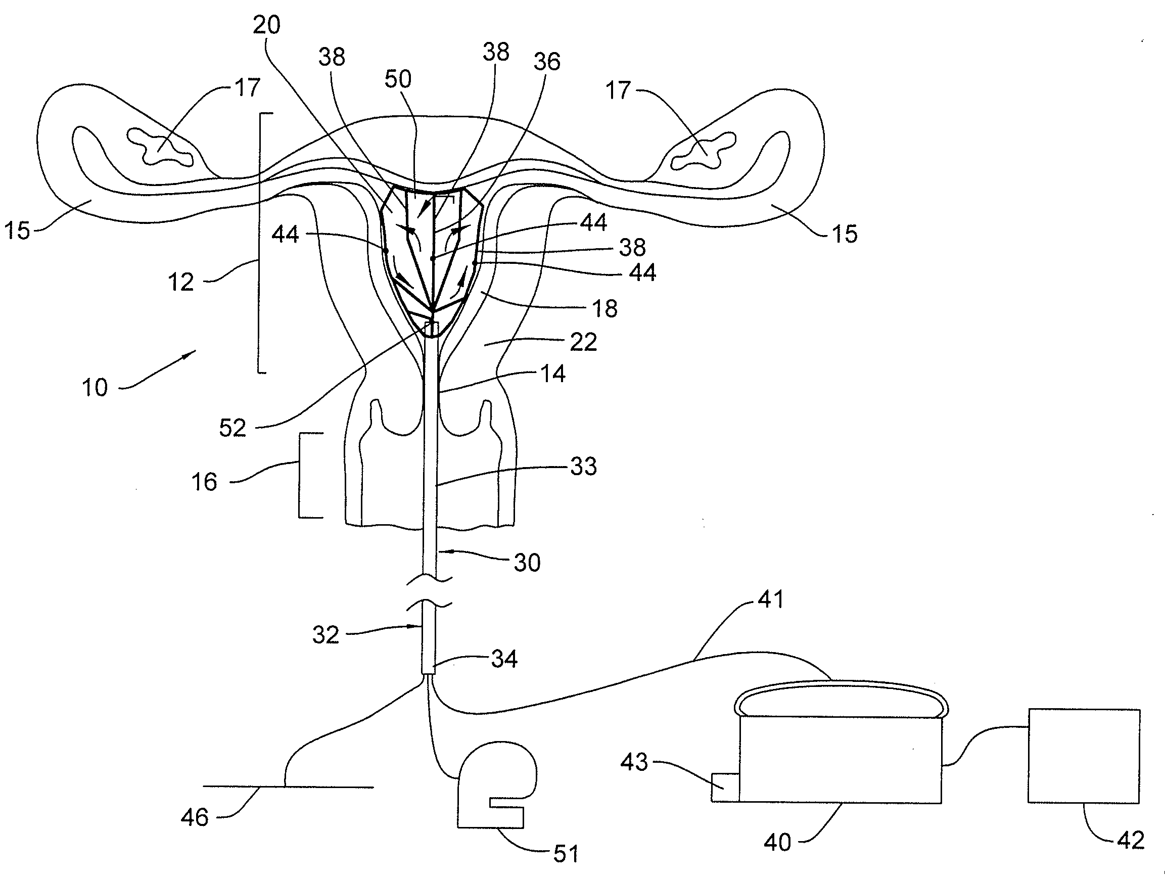 Global endometrial ablation device