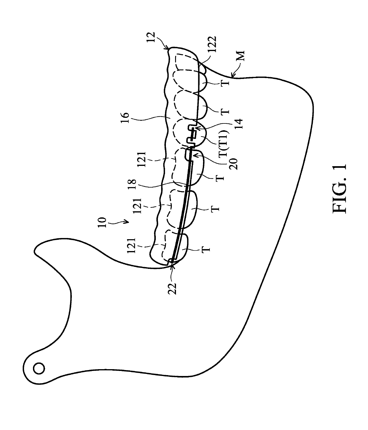 Orthodontic correction device