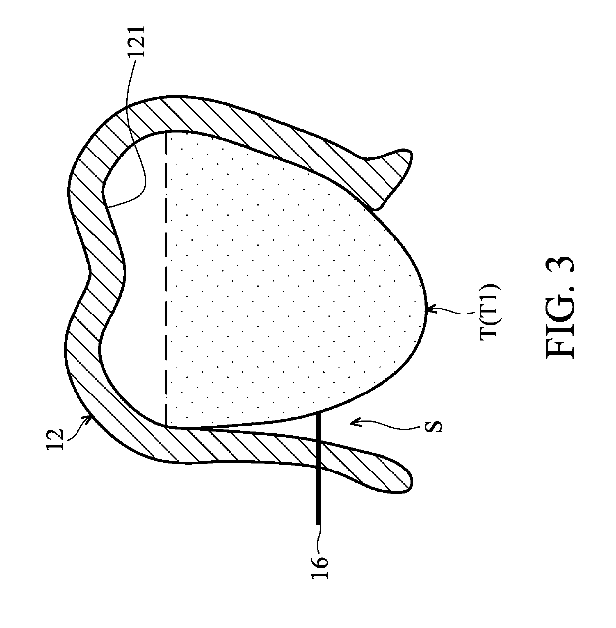 Orthodontic correction device