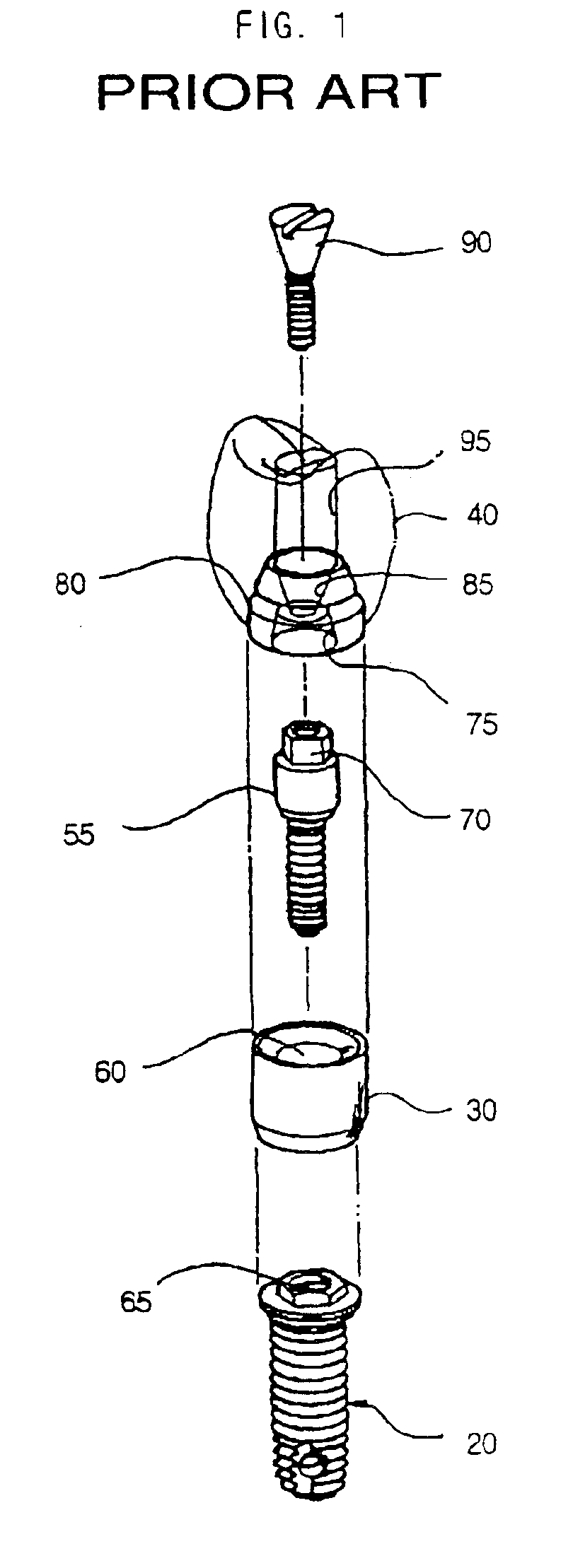 Dental implant and head for a compaction drill