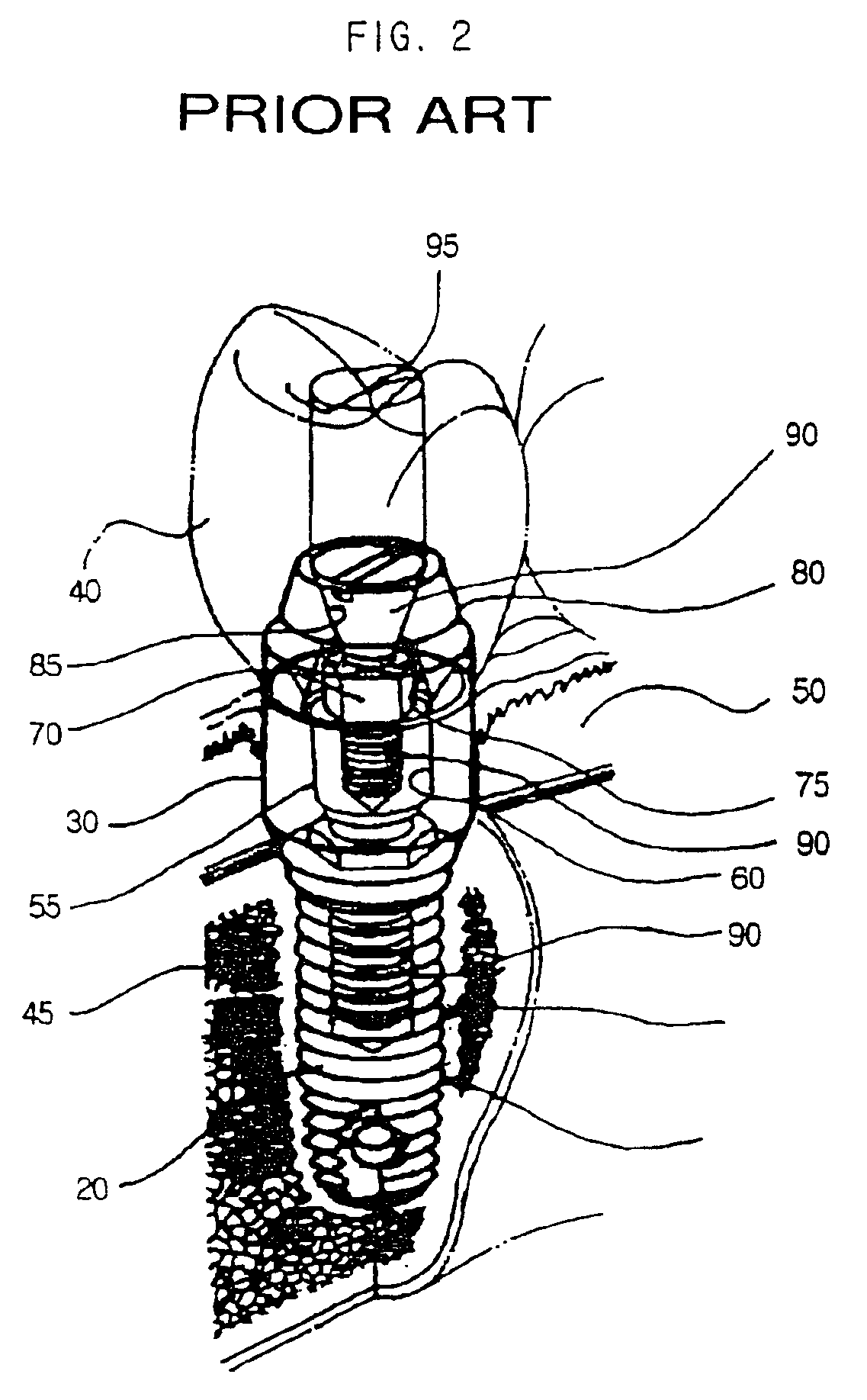 Dental implant and head for a compaction drill