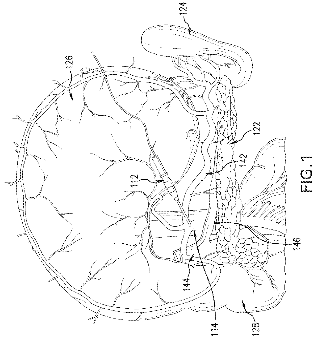 METHOD FOR REVERSING RECENT-ONSET TYPE 1 DIABETES (T1D) BY ADMINISTERING SUBSTANCE P (sP)