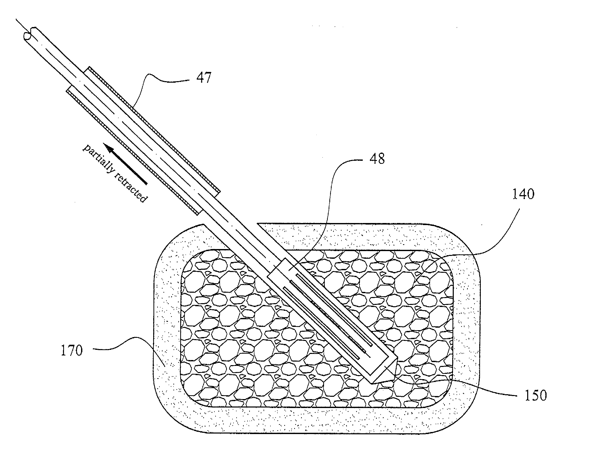 Vertebroplasty methods with optimized shear strength and crack propagation resistance