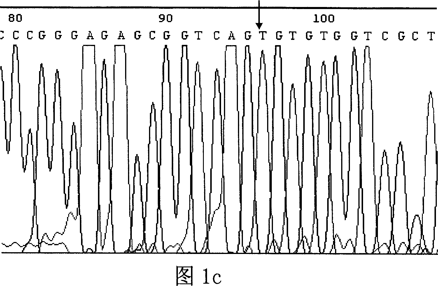 Method for determining patient's brain ictus genetic susceptibility