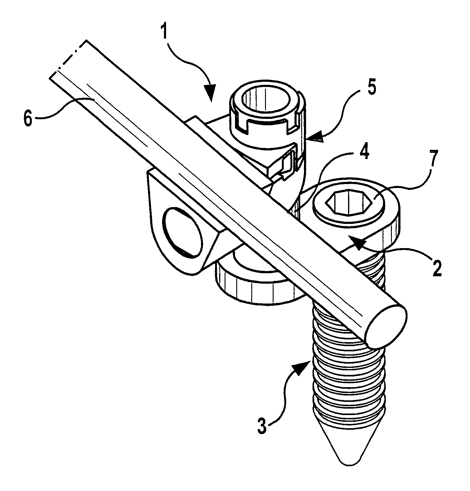 Offset orthopedic fixation device with locking mechanism