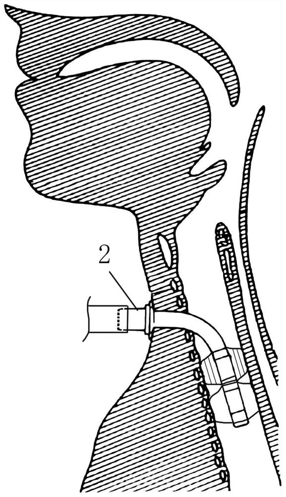 Voice training rehabilitation device used after tracheotomy