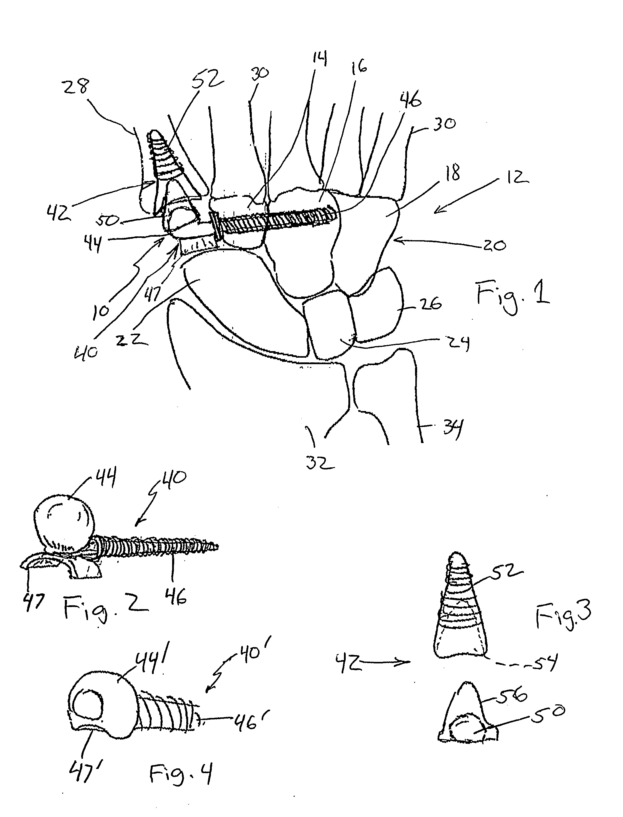 Semi-Constrained 1st Carpometacarpal Implant Arthroplasty