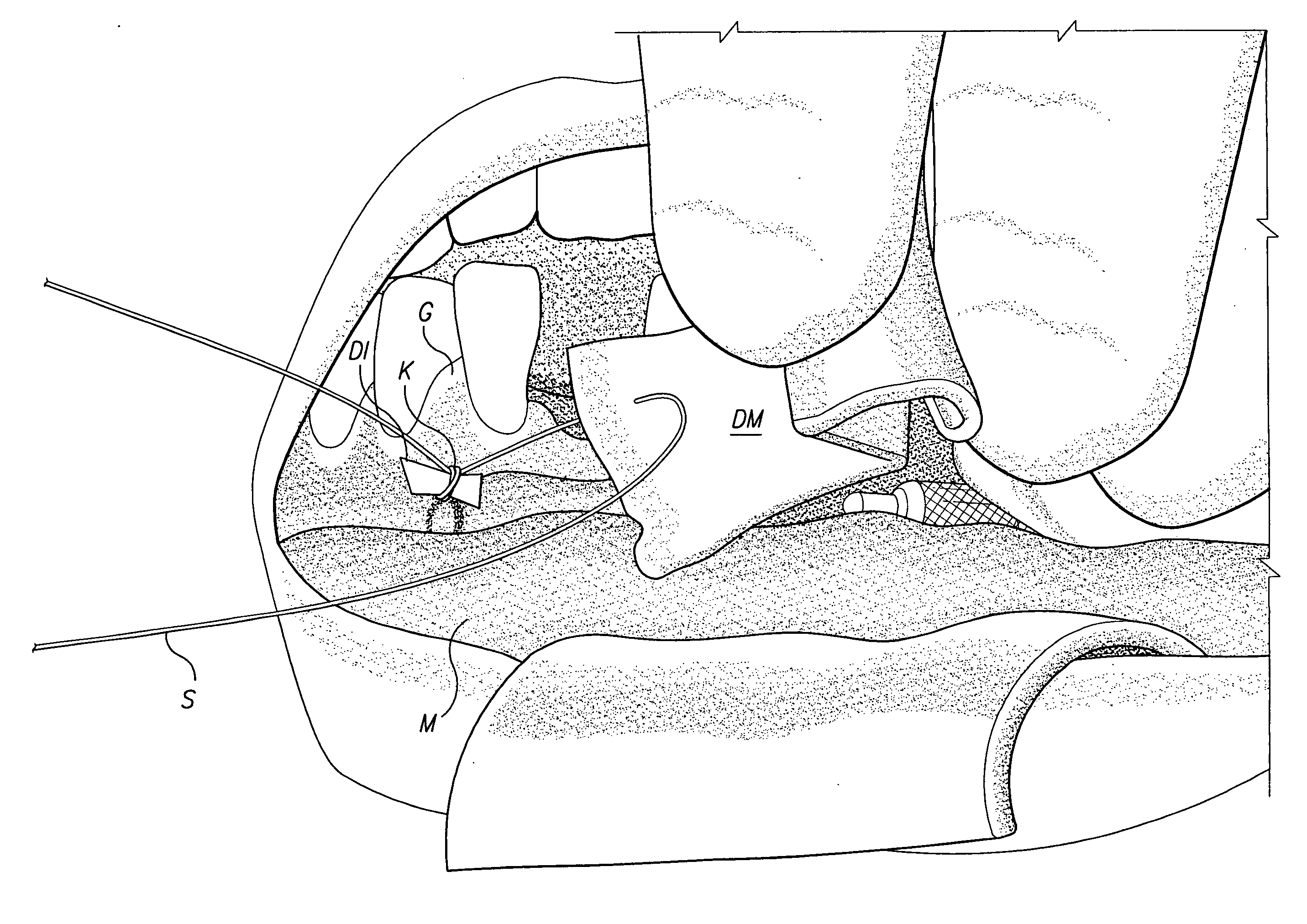 Tunneling method for dental block grafting