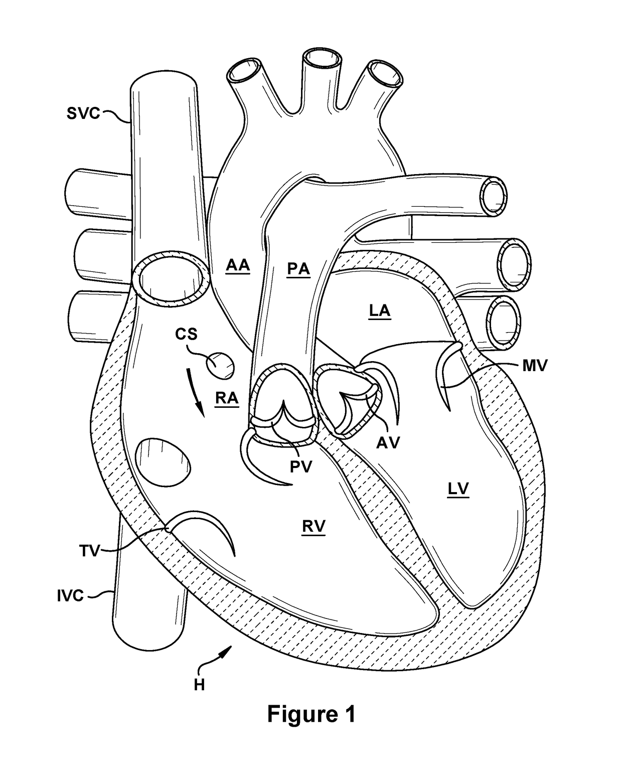 Native valve repair devices and procedures