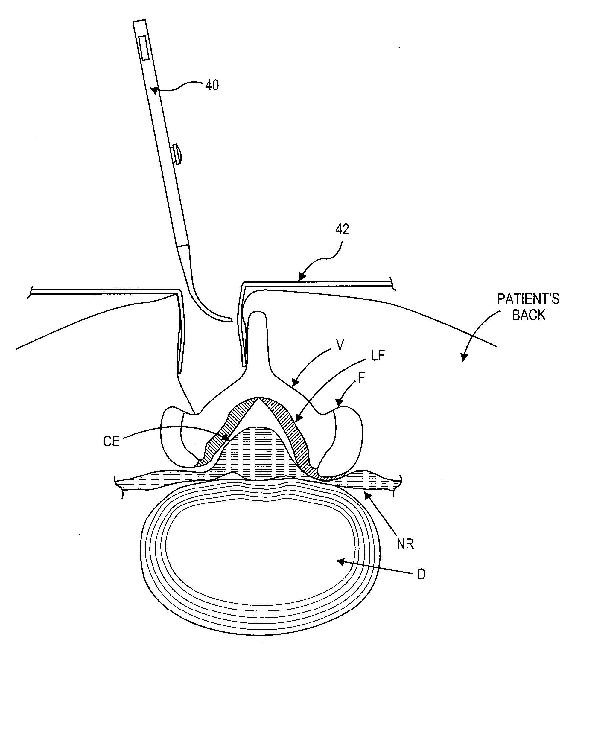 Surgical probe and method of making