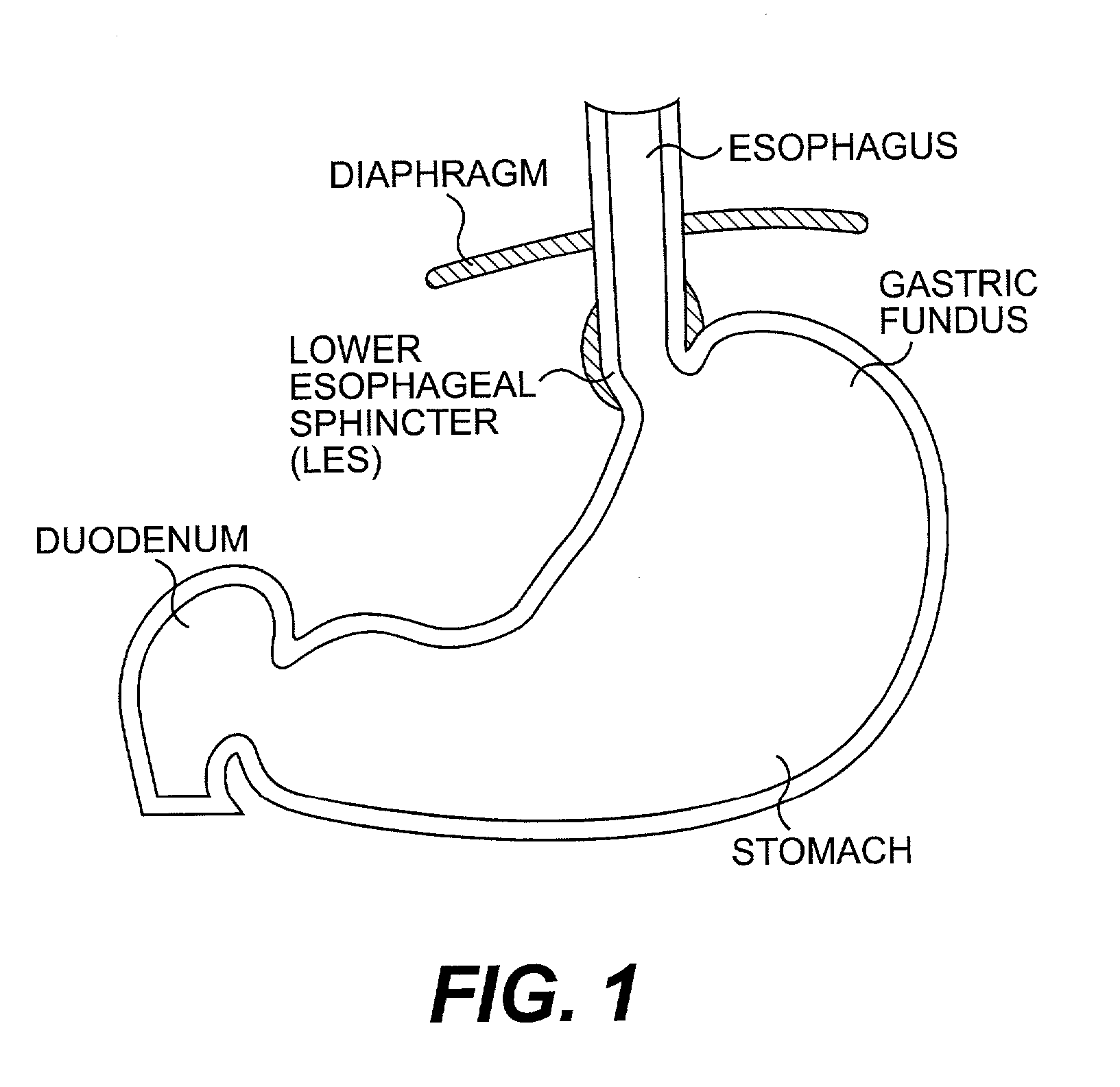 Tissue fastening devices and related insertion tools and methods