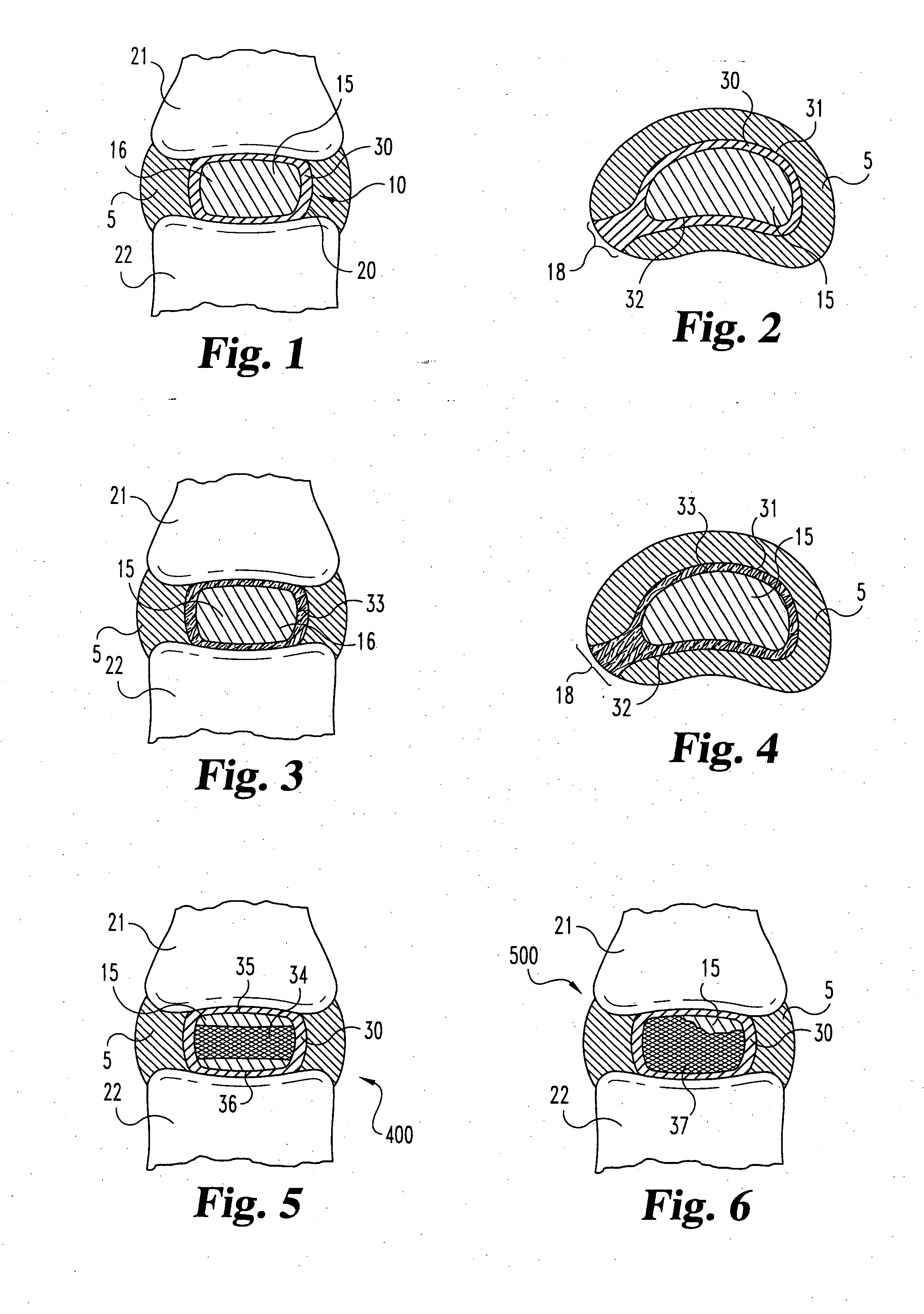 Intervertebral disc nucleus implants and methods