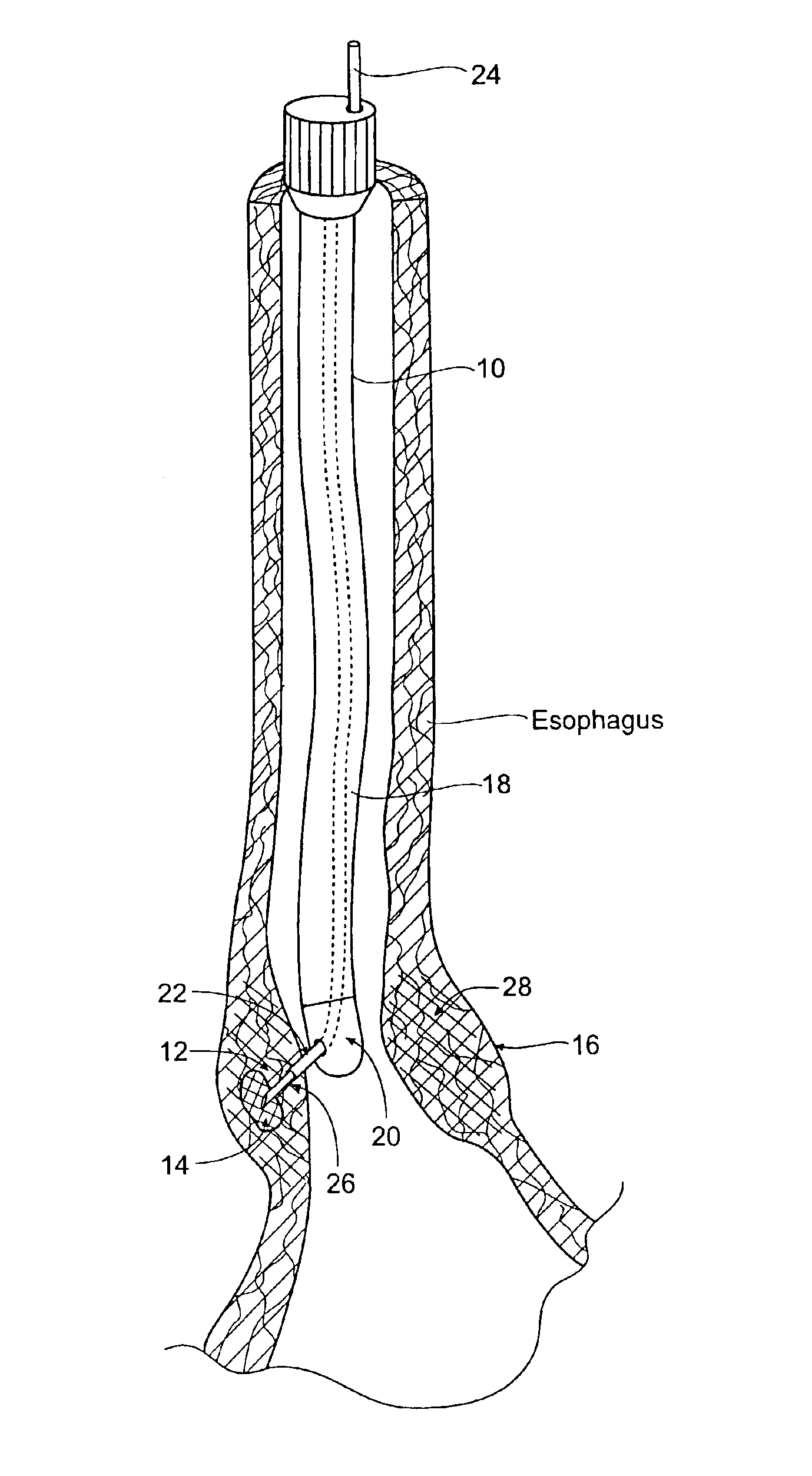 Method for treating a sphincter