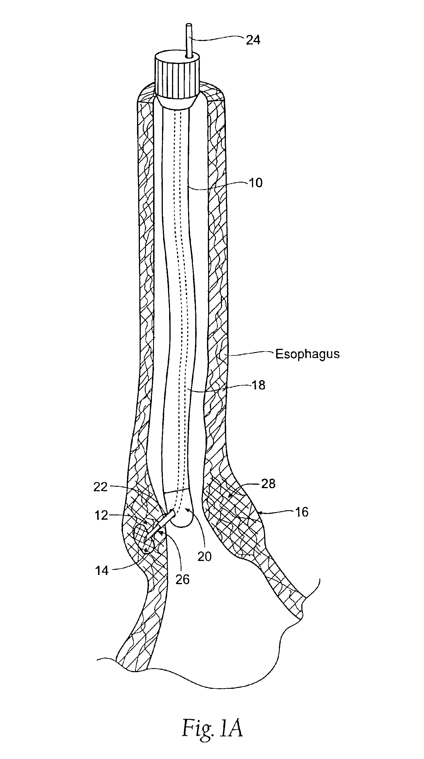 Method for treating a sphincter