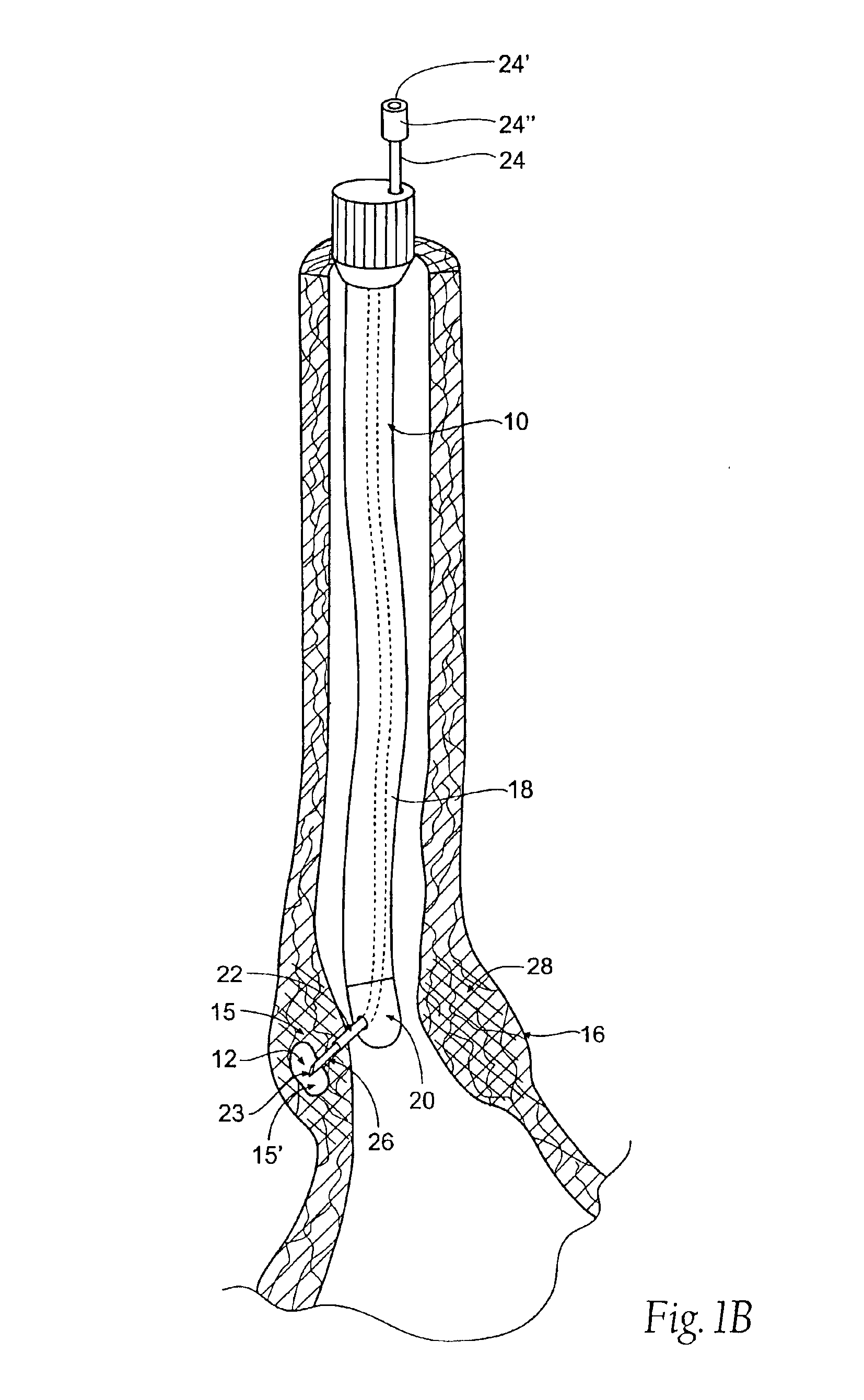 Method for treating a sphincter