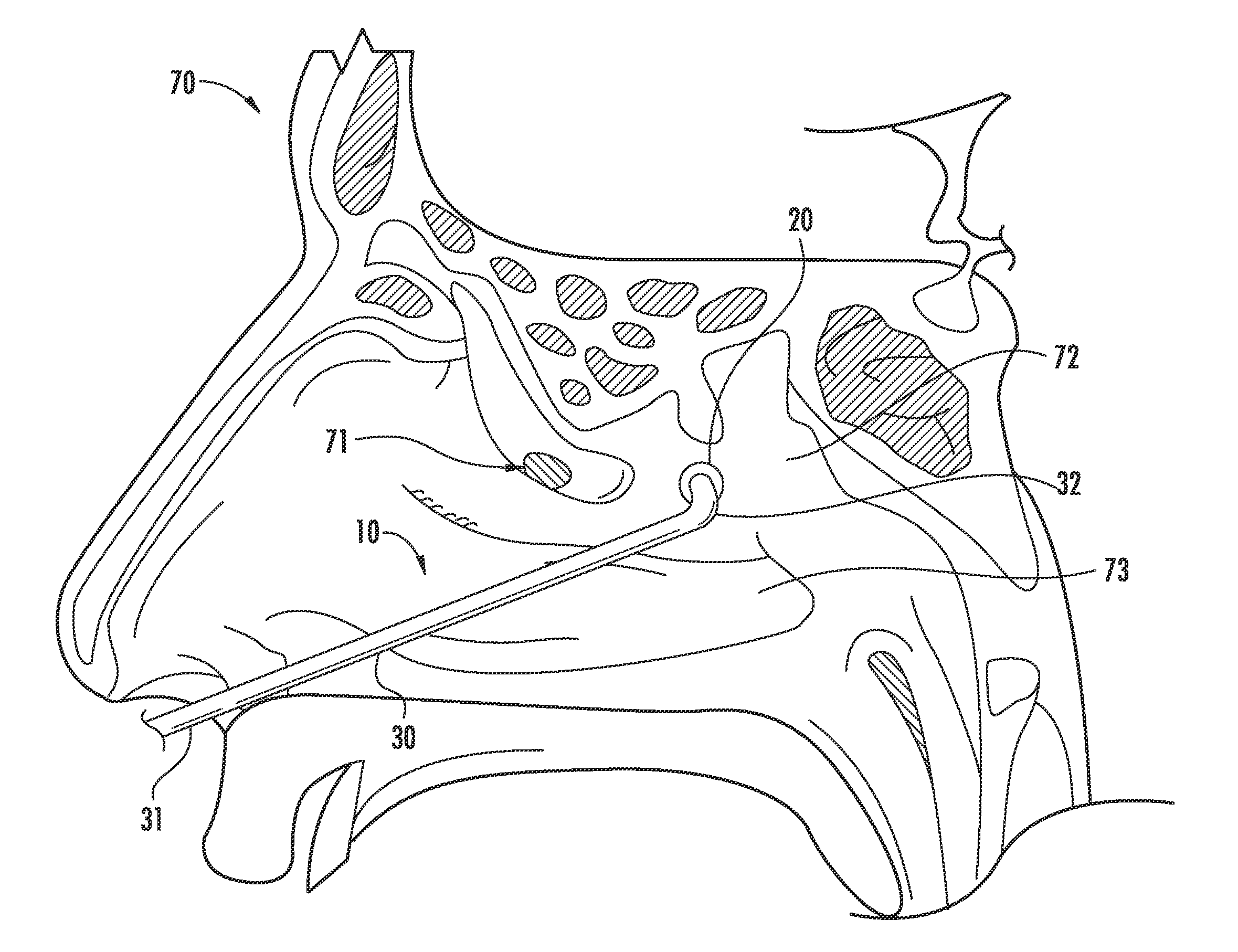 Nasal ventilation system and method of using same