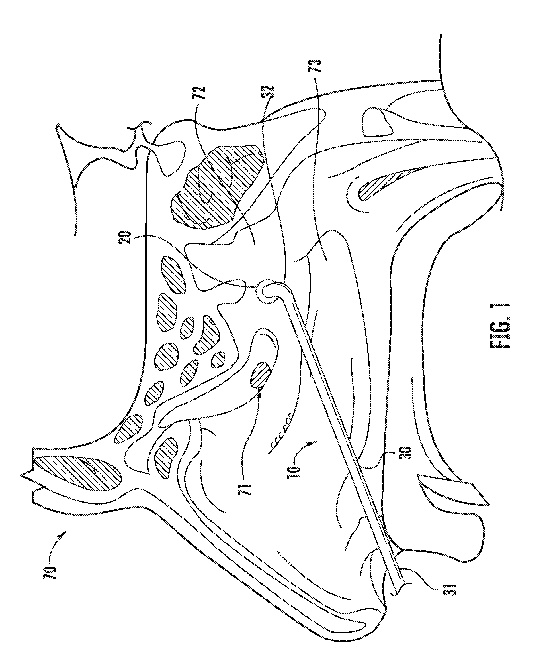 Nasal ventilation system and method of using same