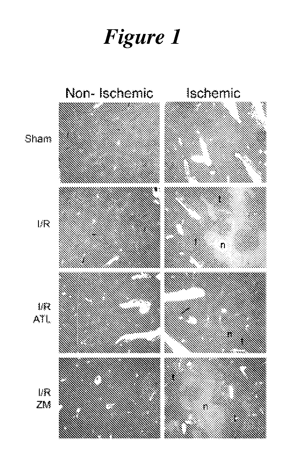 Agonists of a2a adenosine receptors for treating recurrent tumor growth