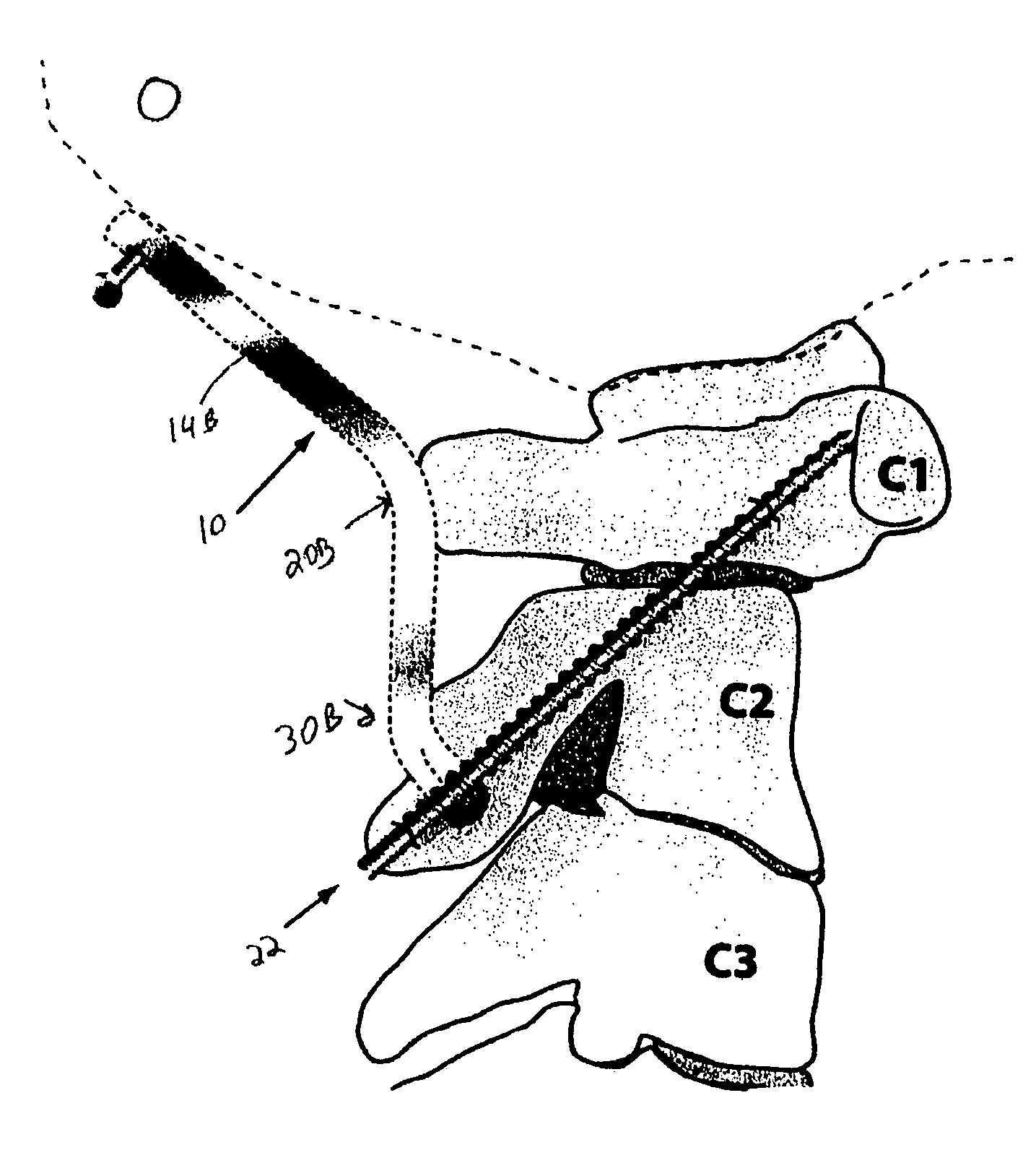 Occipitocervical plate