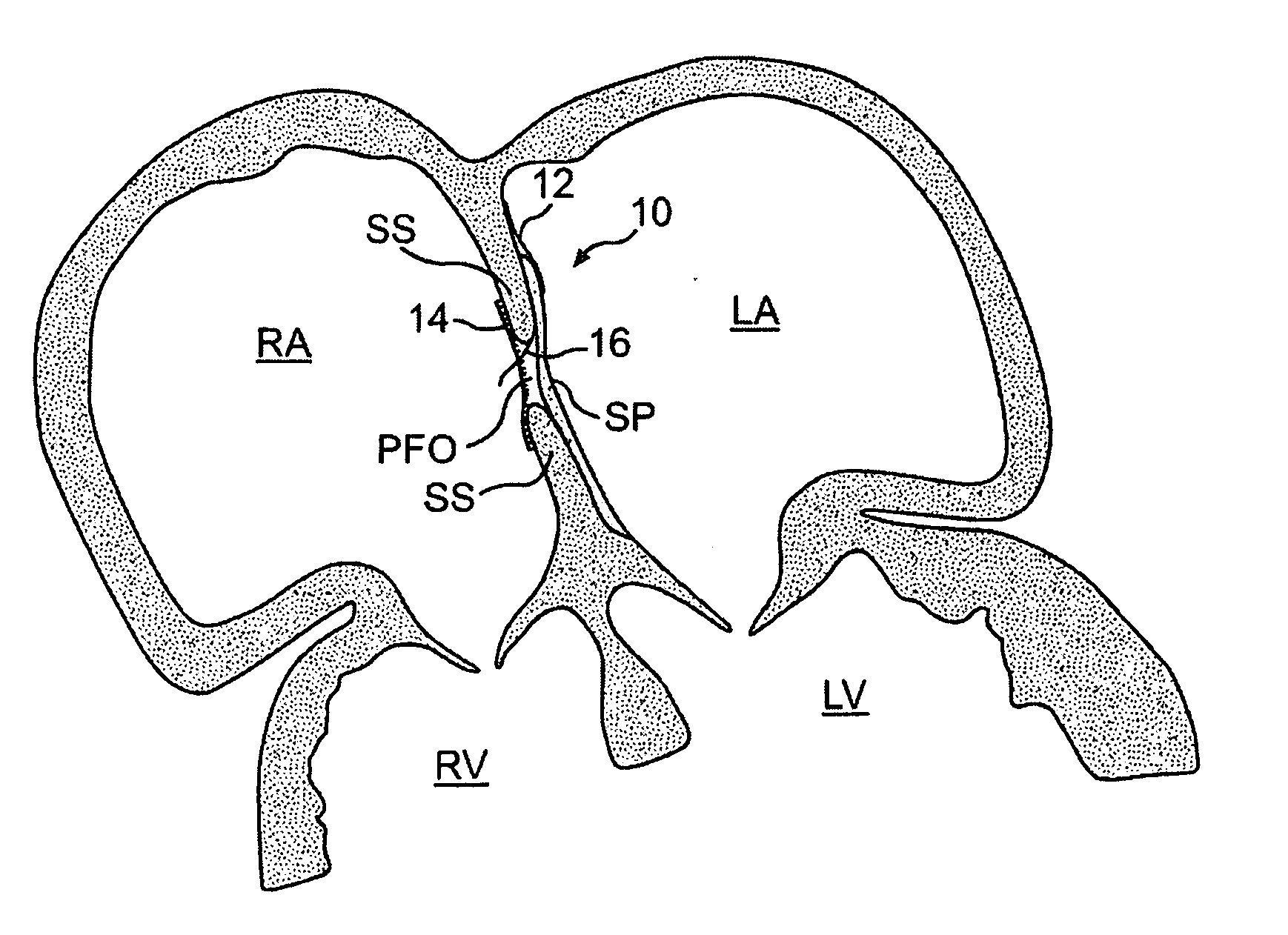 Closure devices, related delivery methods and tools, and related methods of use