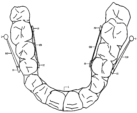 Personalized customized invisible orthodontic appliance for III type malocclusion