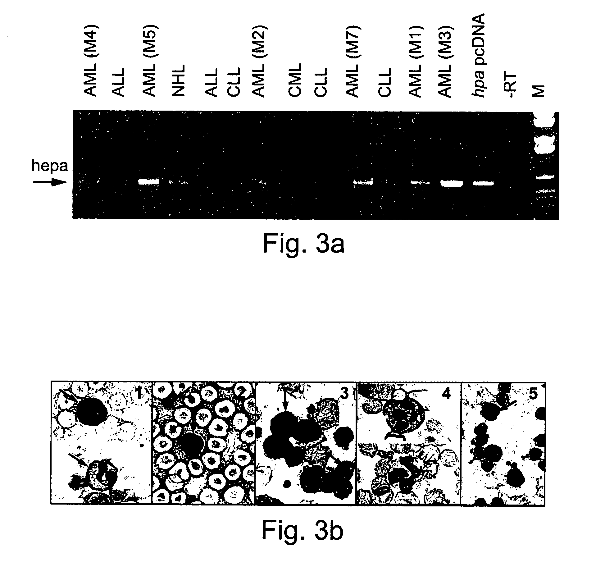 Methods and kits for diagnosing and monitoring hematopoietic cancers