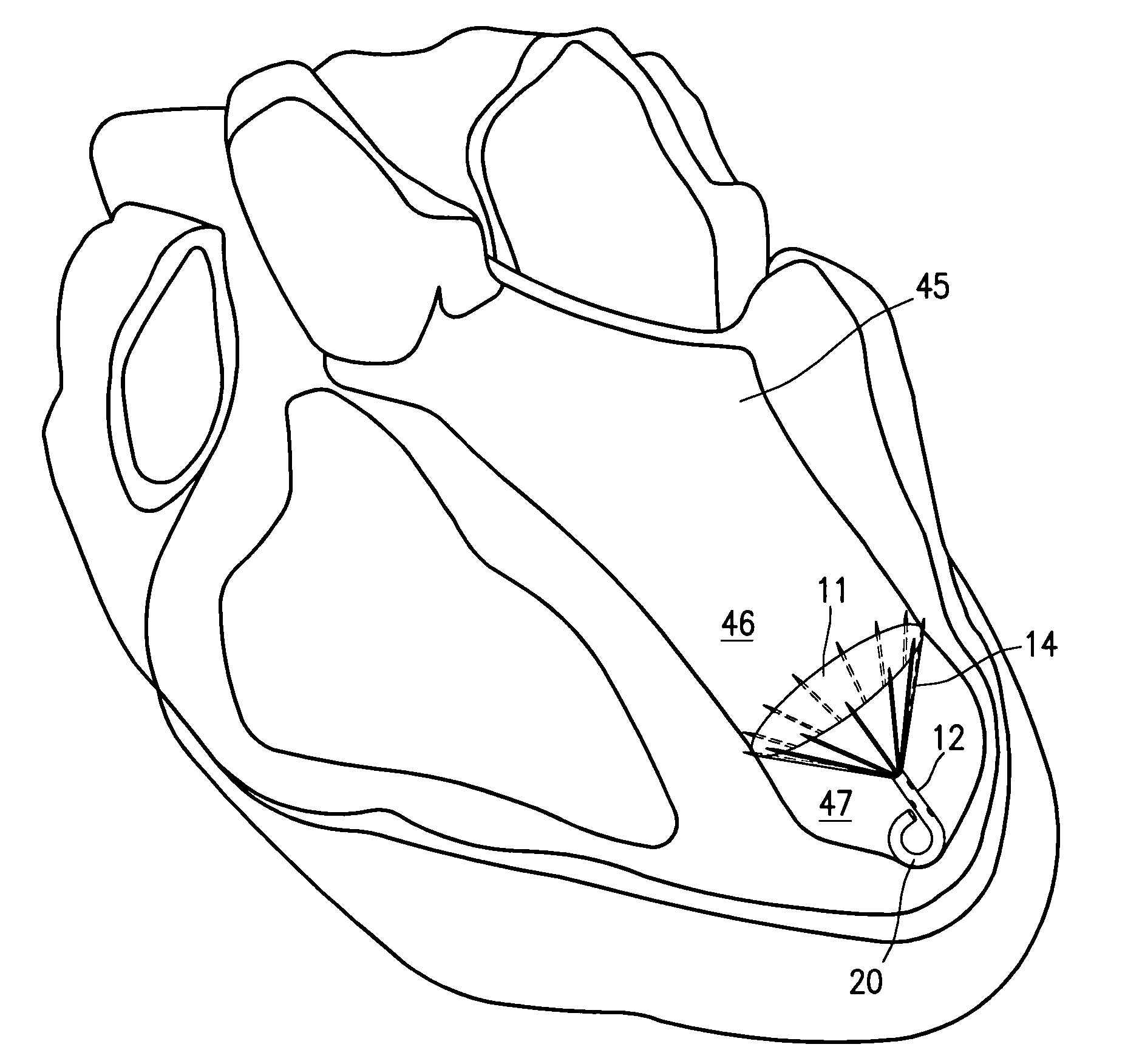 Ventricular partitioning device