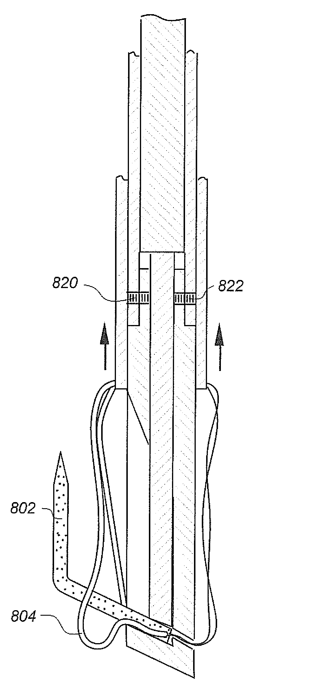 Soft tissue repair methods and apparatus