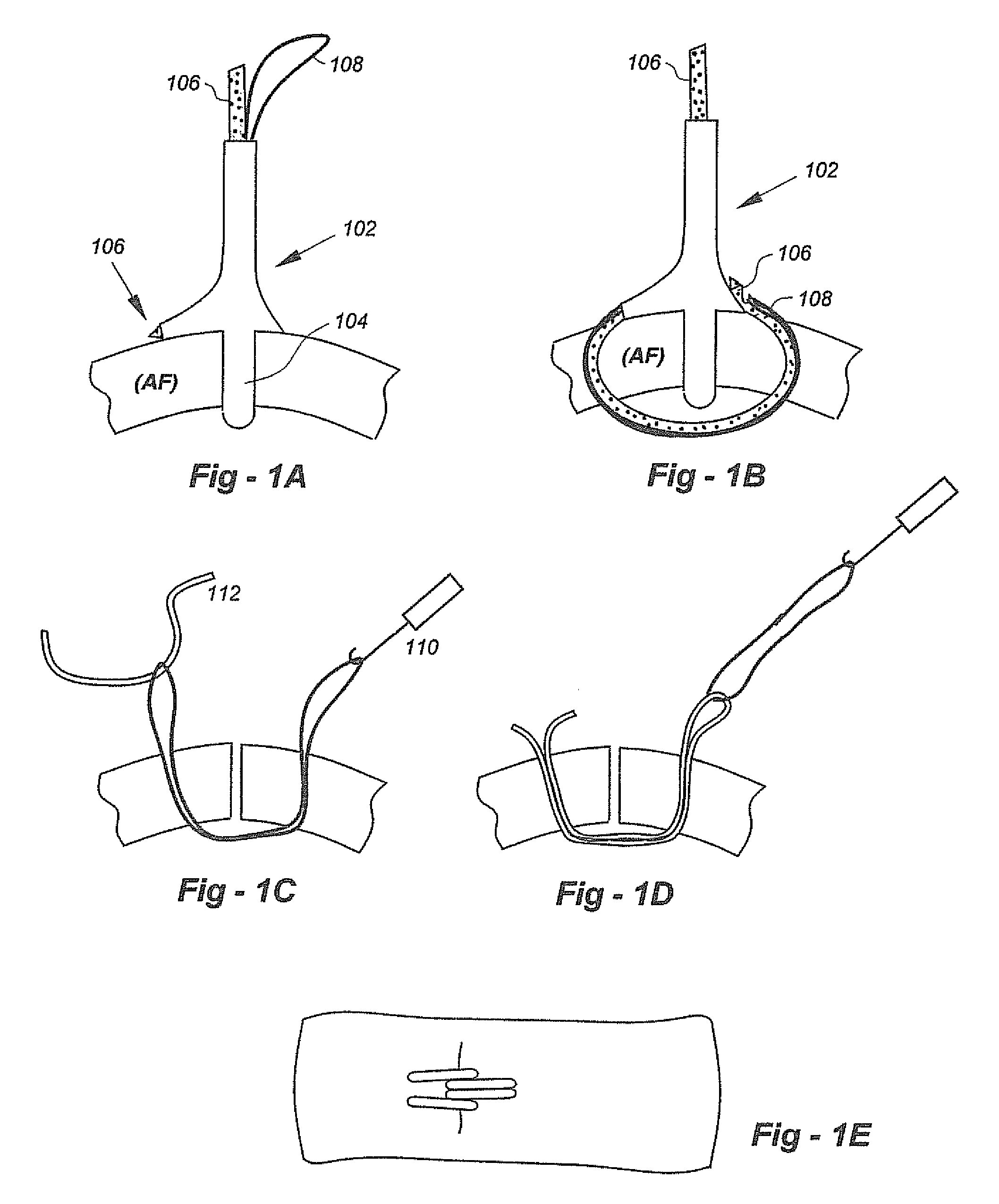 Soft tissue repair methods and apparatus