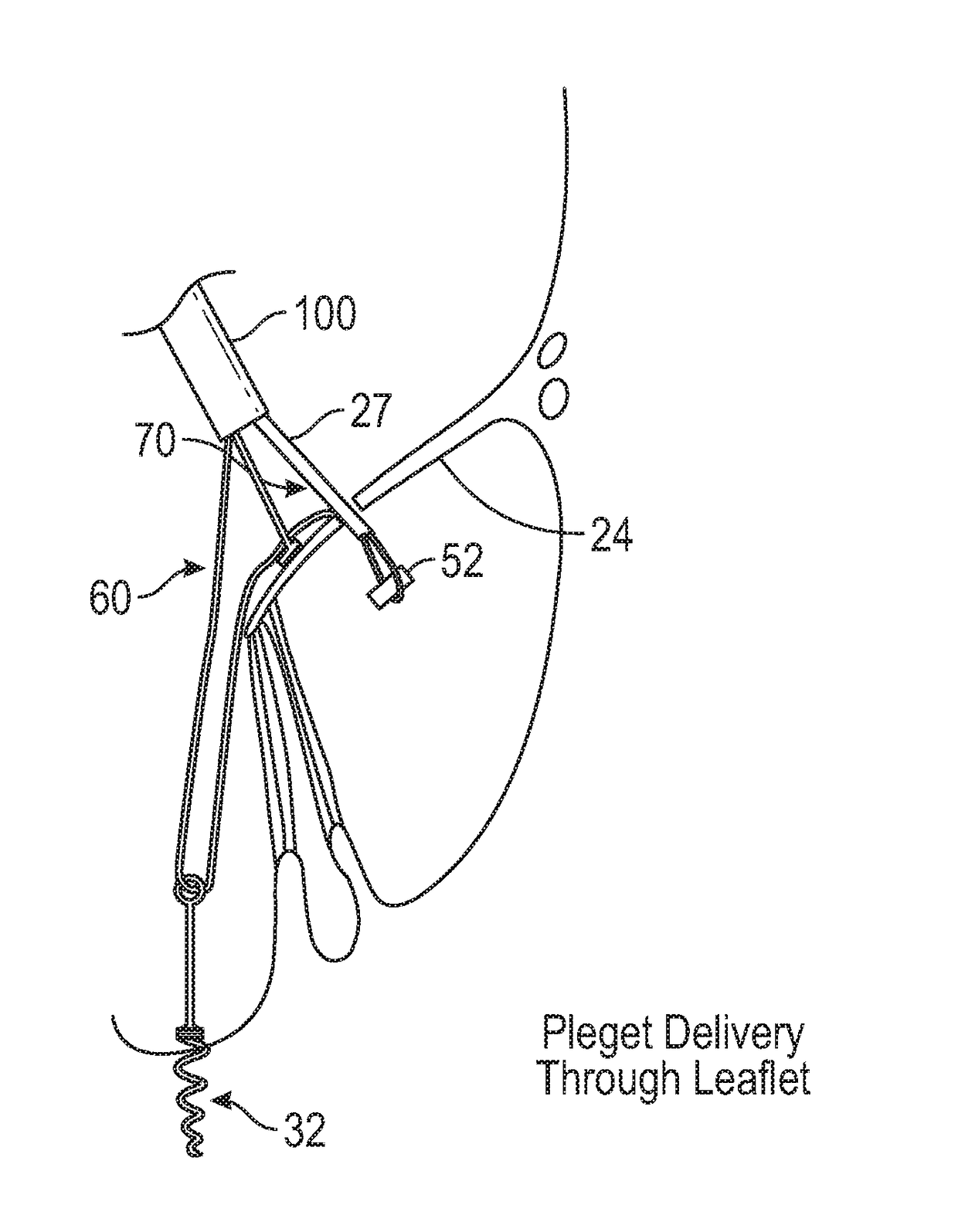 Method and apparatus for transvascular implantation of neo chordae tendinae