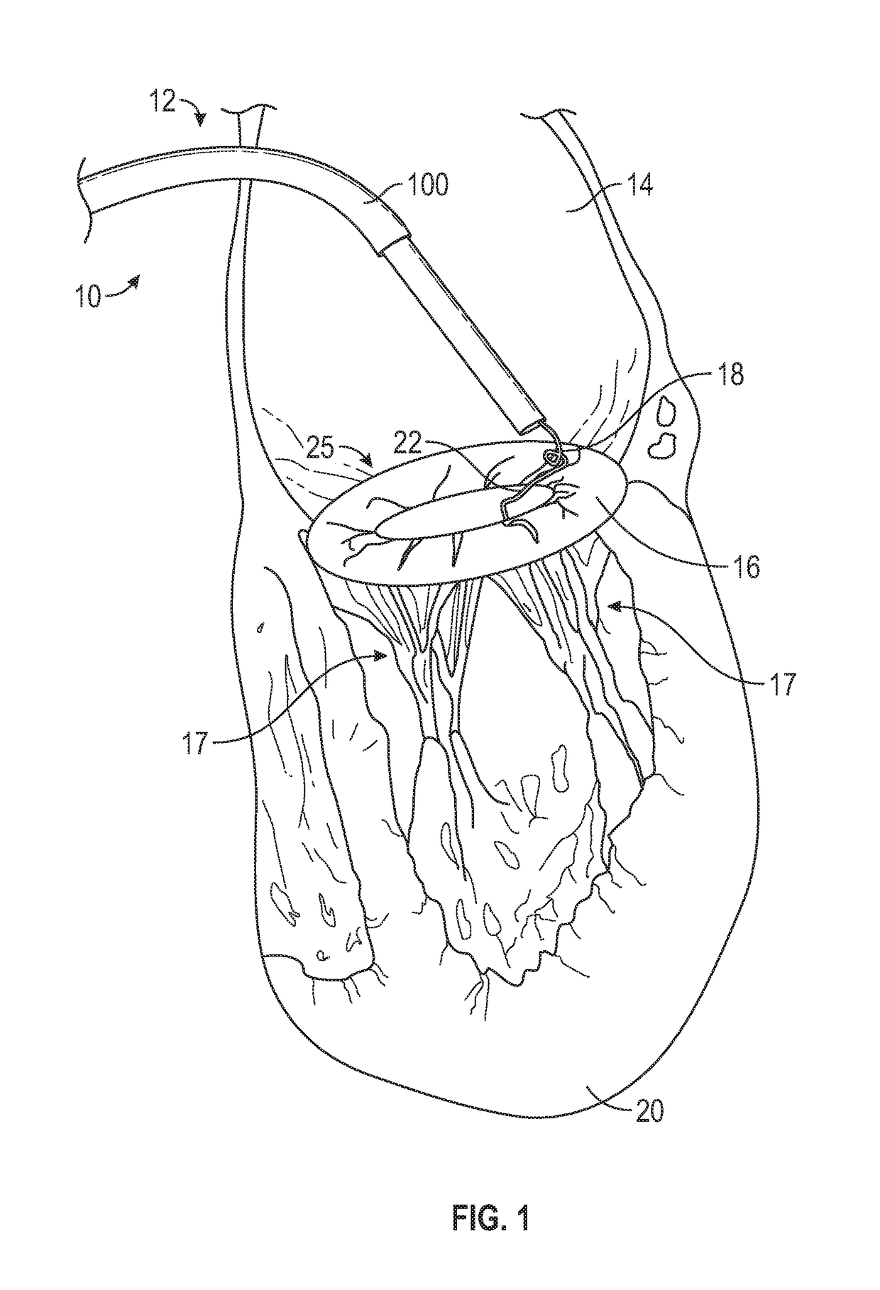 Method and apparatus for transvascular implantation of neo chordae tendinae