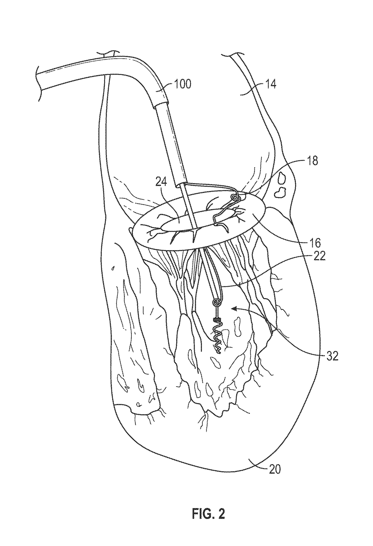 Method and apparatus for transvascular implantation of neo chordae tendinae