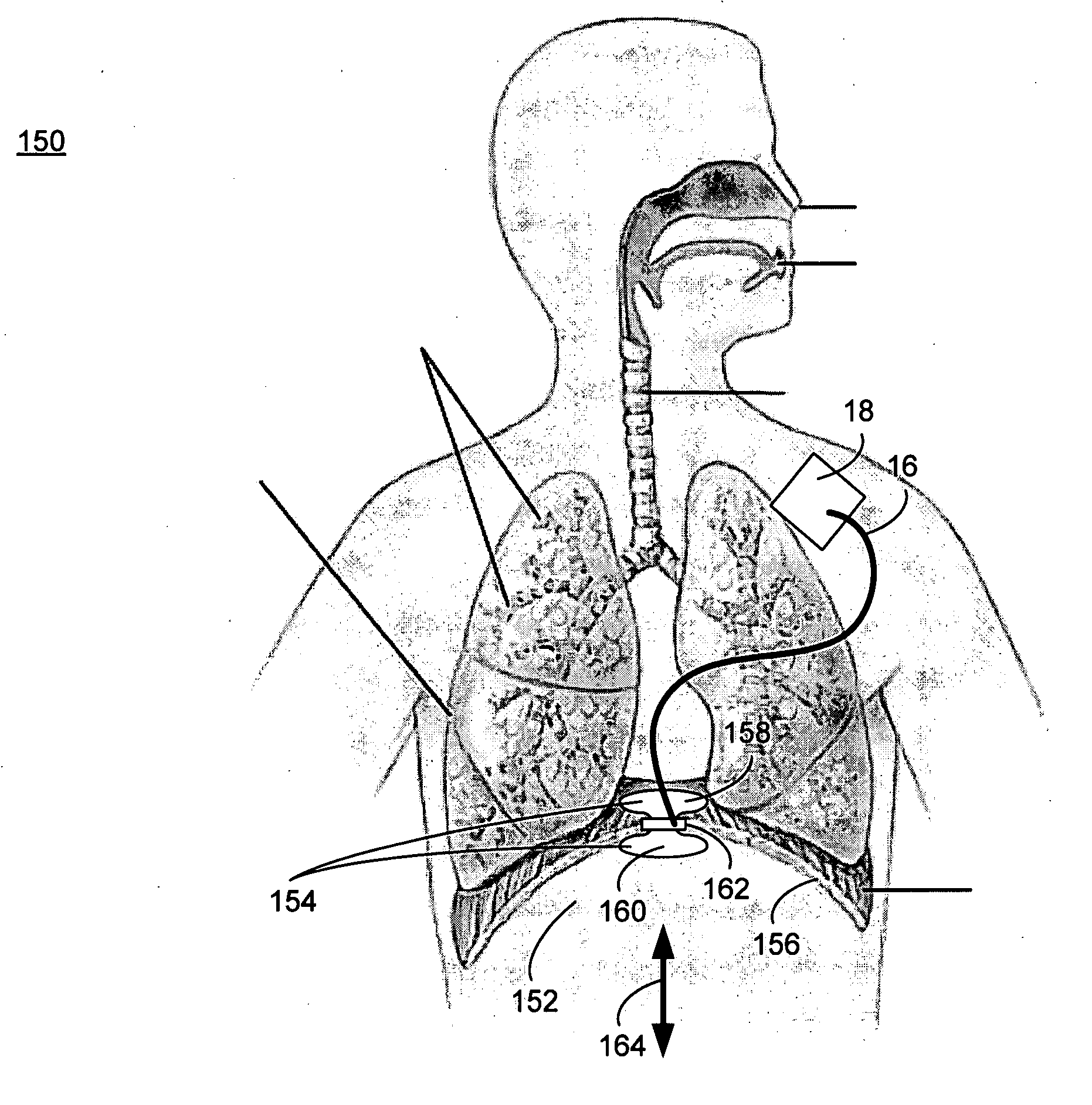 Implantable generating system