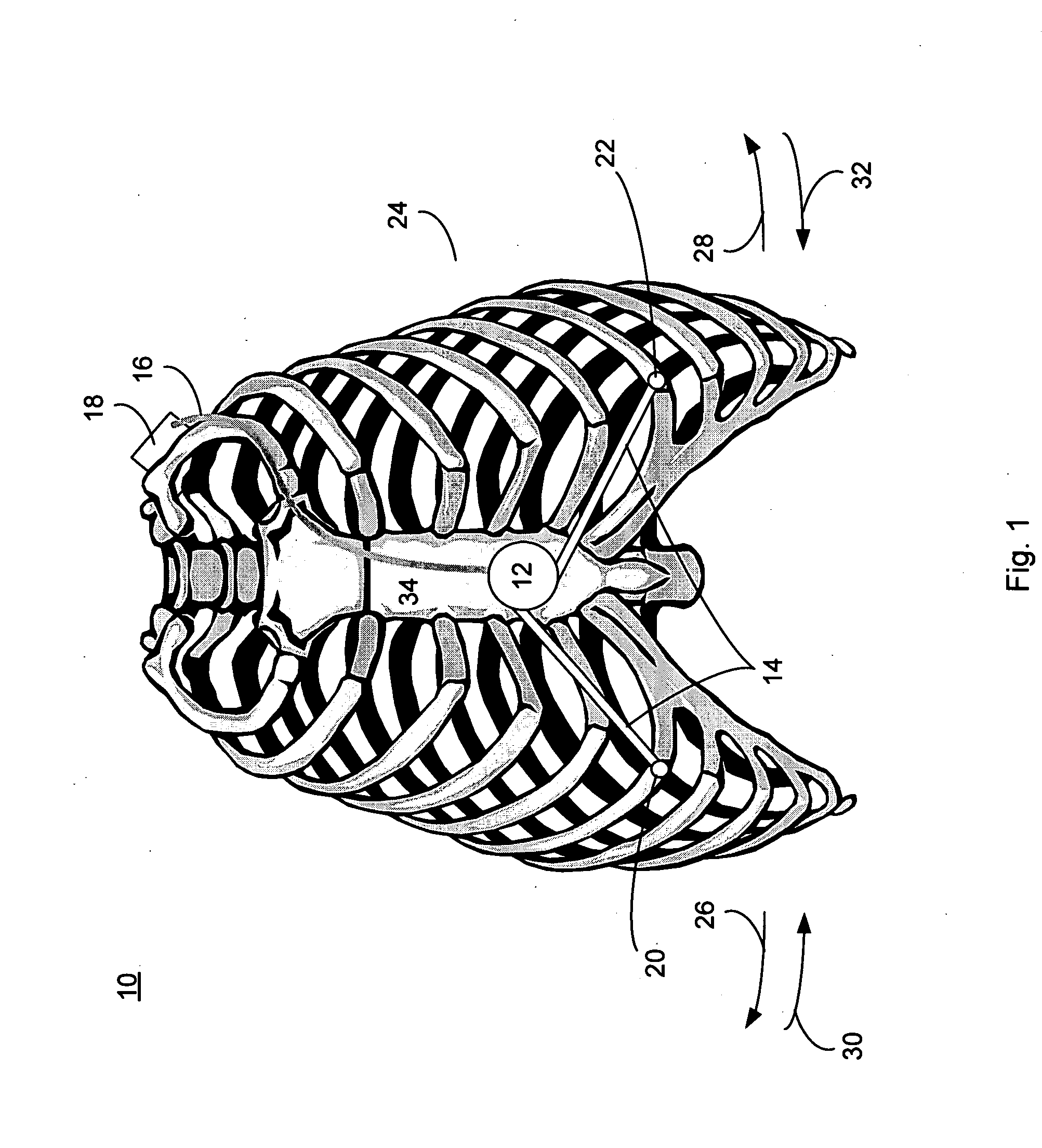 Implantable generating system