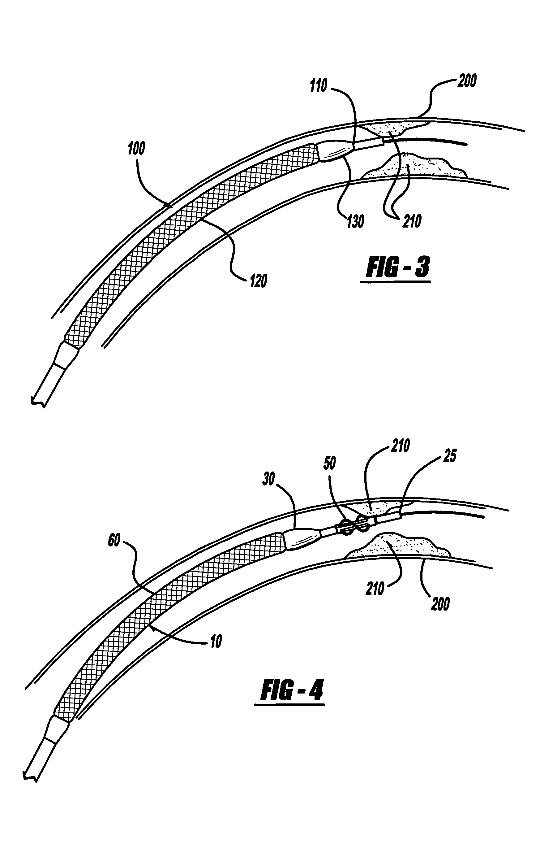 Spiral centering catheter