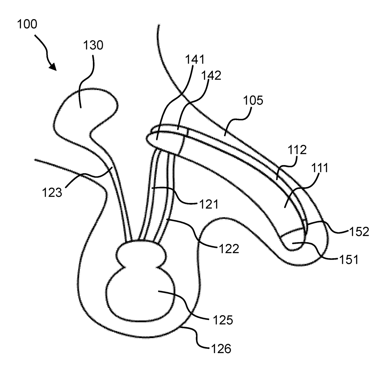 Penile implant with a length-adjustable tube