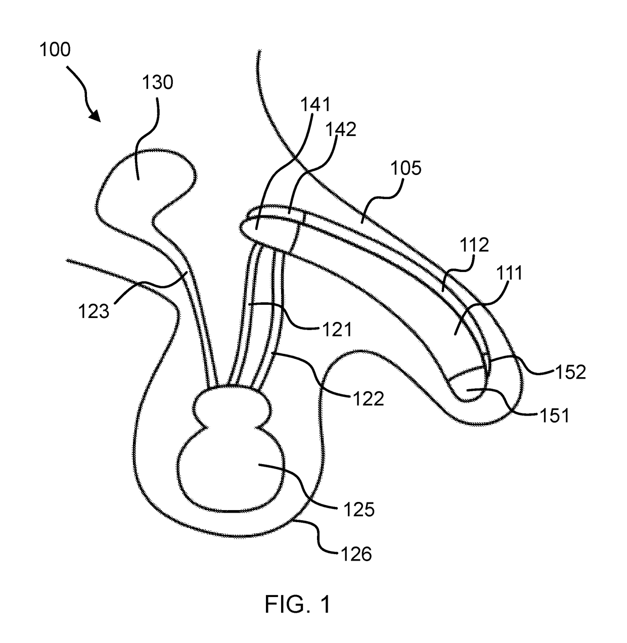 Penile implant with a length-adjustable tube