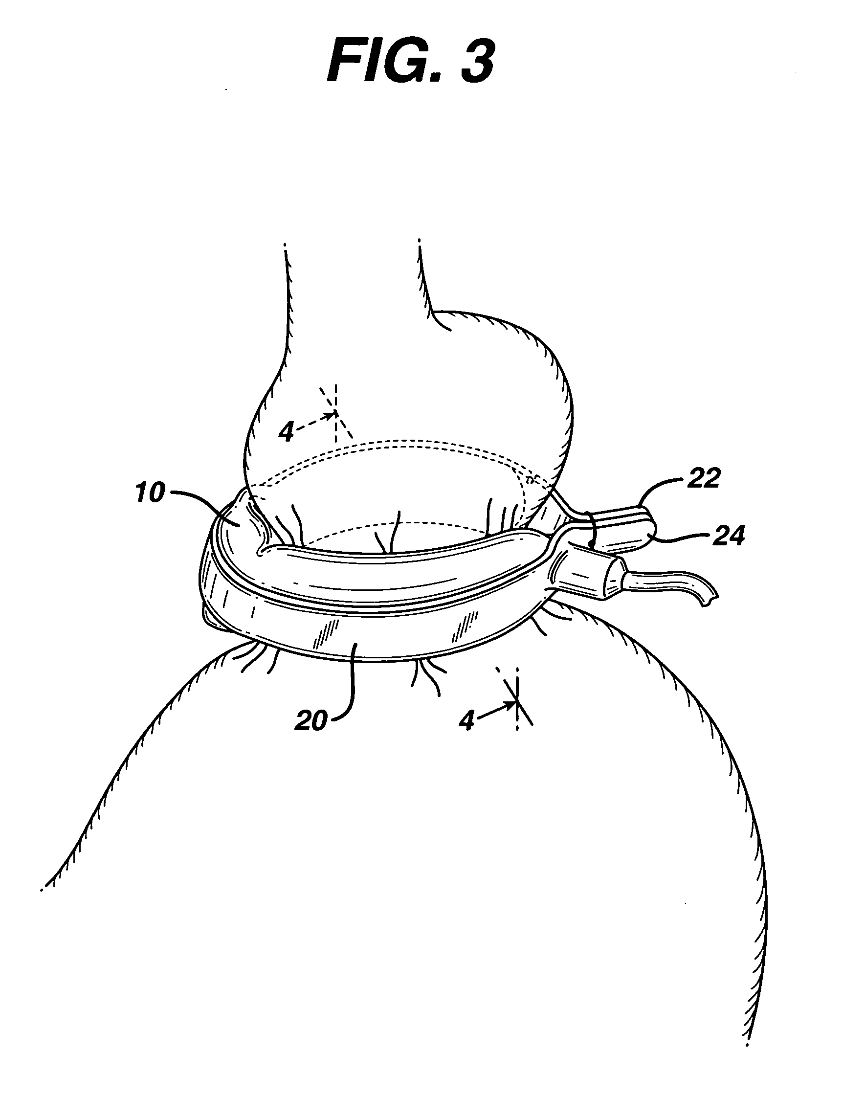 Method for implanting an adjustable band